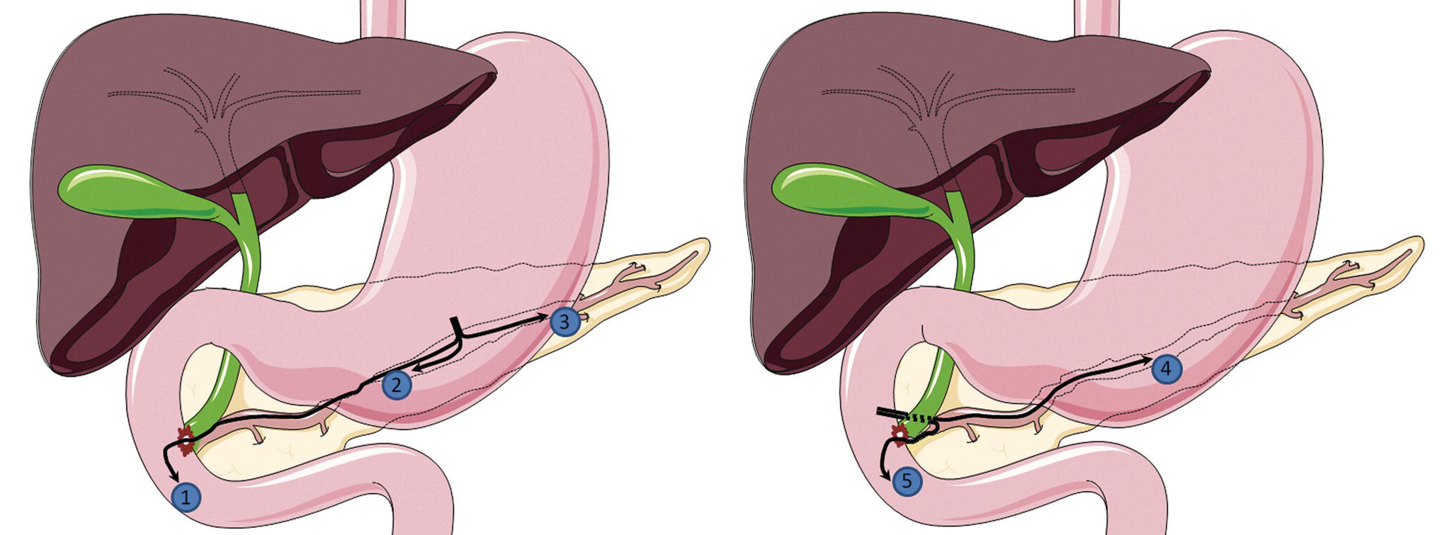 Schematic illustration of access points and routes for EUS-PDD: 1, transgastric rendezvous; 2, transgastric MPD access for antegrade stenting; 3, transgastric MPD access for retrograde stenting; 4, transduodenal MPD access for retrograde stenting; 5, transduodenal rendezvous.