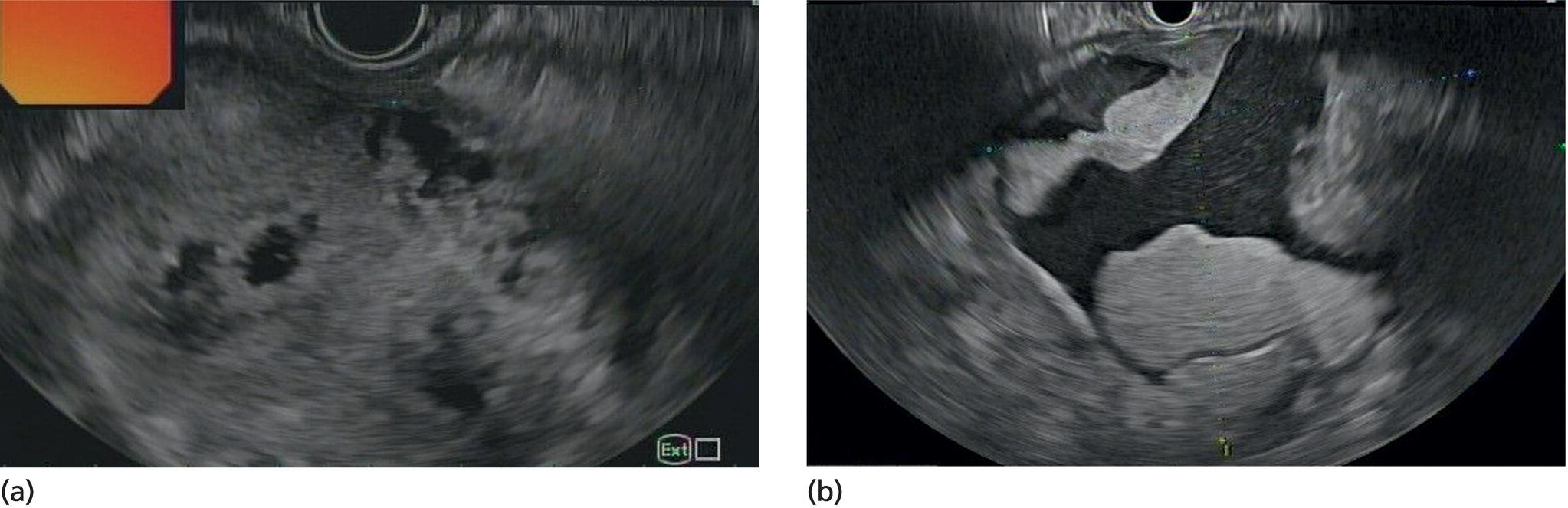 Photos depict (a, b) Hyperechoic and isoechoic solid necrosis within necrotic collections.