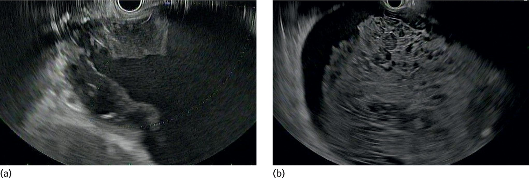 Photos depict (a, b) Clots and blood products within a peripancreatic collection which can have similar appearance to solid necrosis.