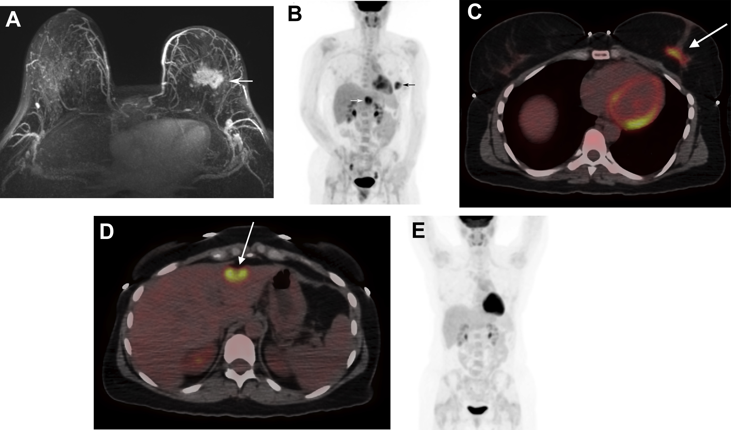 18 F]FDG-PET/CT in a 40-year-old woman with previous breast cancer