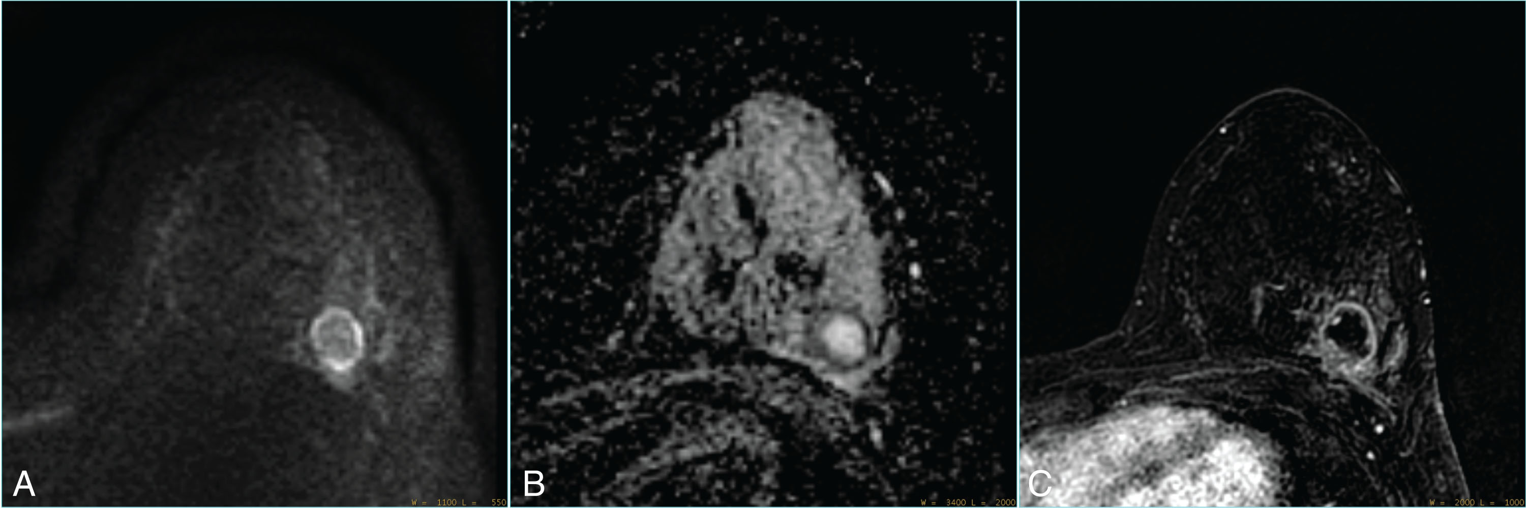 Breast Diffusion Mri Acquisition And Processing Techniques The Ge Healthcare Perspective 1636