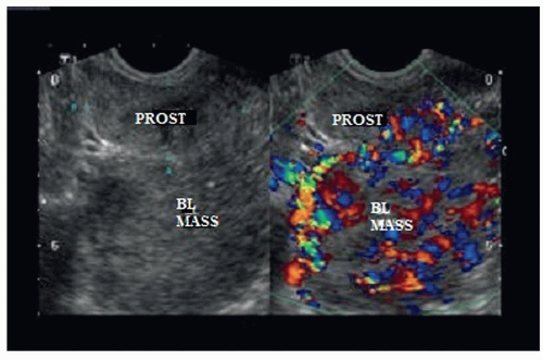 The Lower Urinary Tract Radiology Key