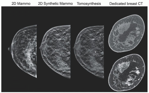 Geometry of the breast. Upper part of the breast is a half cone