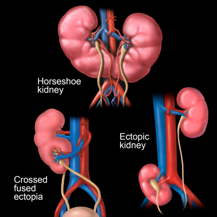 Pelvic Kidney Horseshoe Horseshoe Kidney Pelvic Kidney Horseshoe Horseshoe Kidney