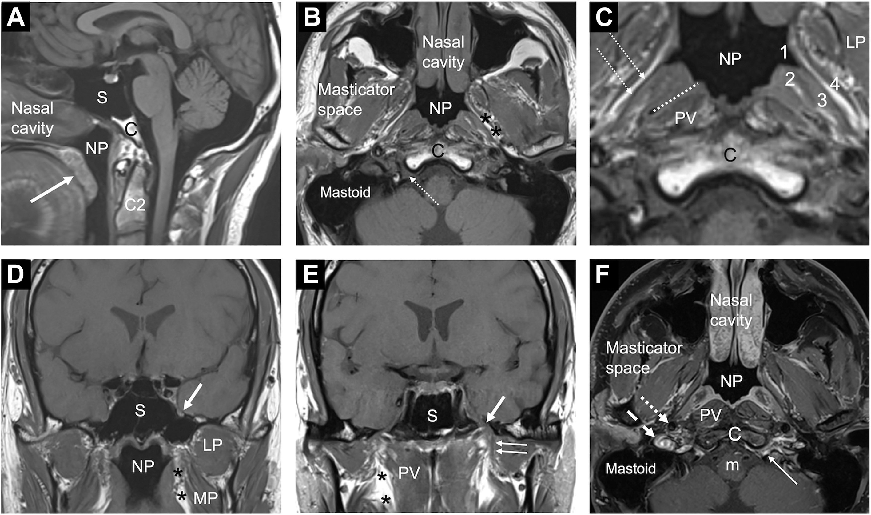 An M R I panel labeled A to F showing nasopharyngeal anatomy and adjacent structures with labels such as N P, S, P V, C, and arrows marking anatomical spaces and muscles.