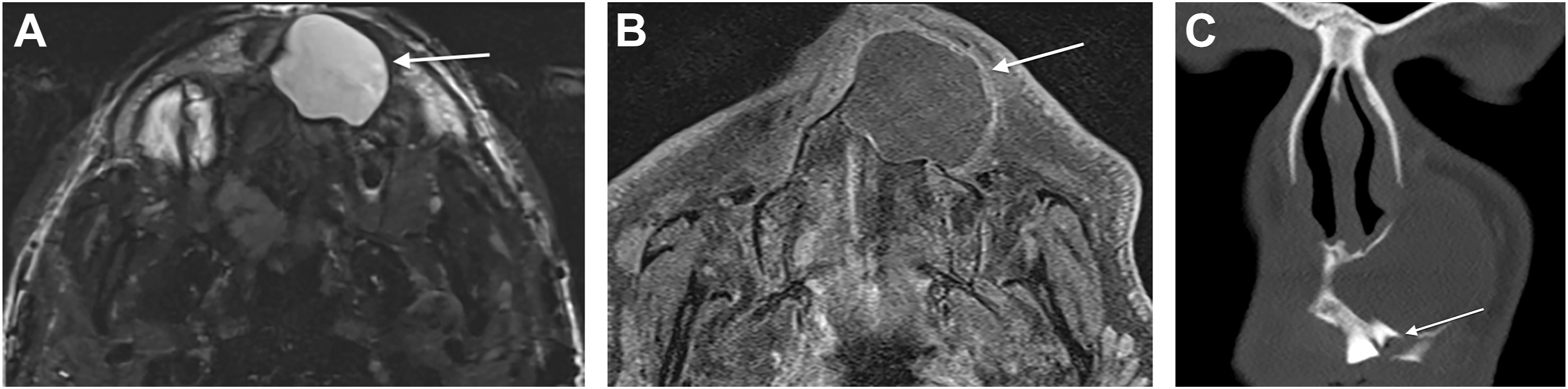 Three axial T 2 SPACE scans show cystic lesions near the maxillary region with smooth boundaries and well-defined margins.