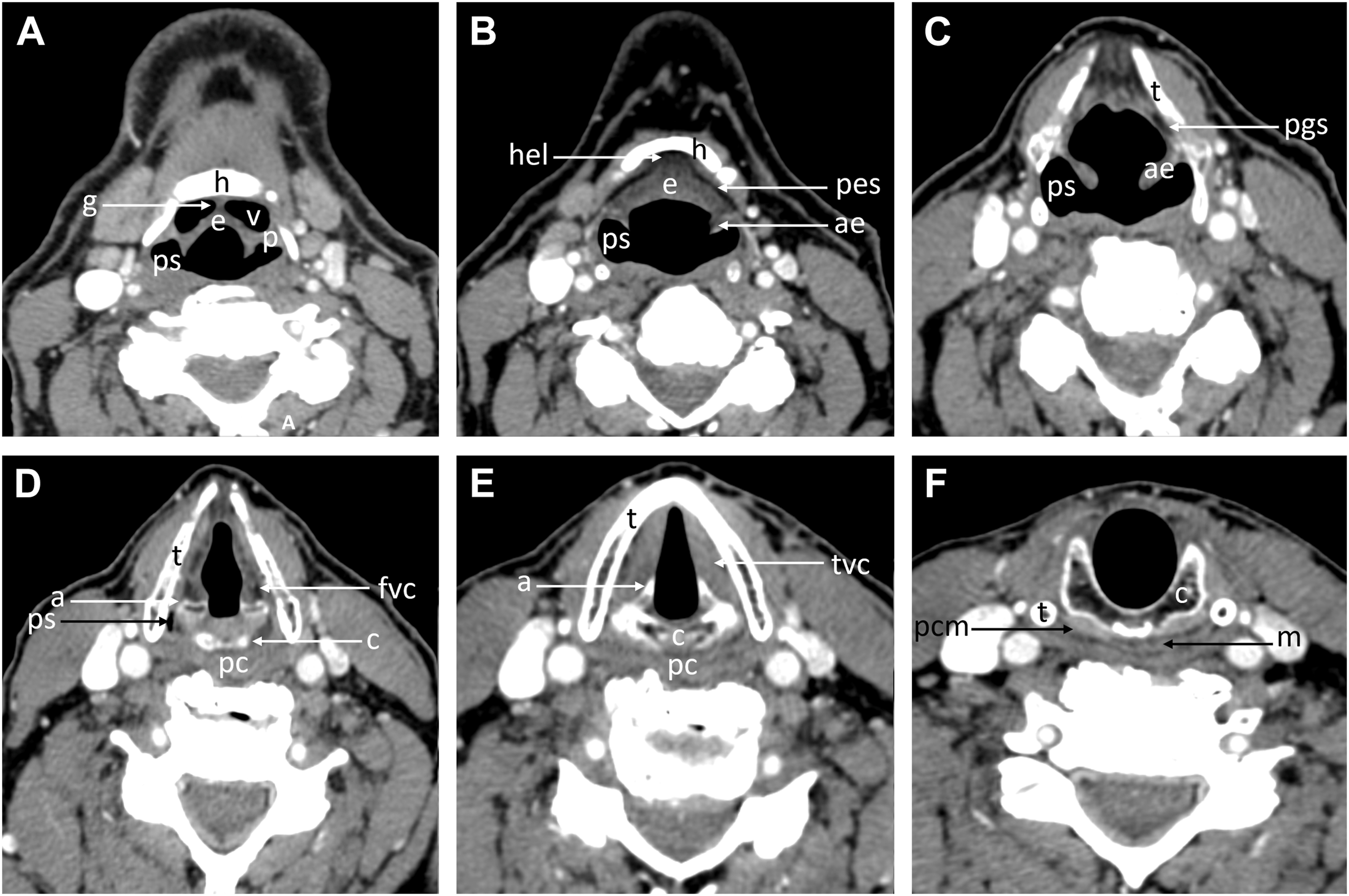 A set of axial C T scans shows labeled cross-sections of the head and neck, including the hyoid, pharyngeal muscles, airways, and various structures, with letters indicating key regions.