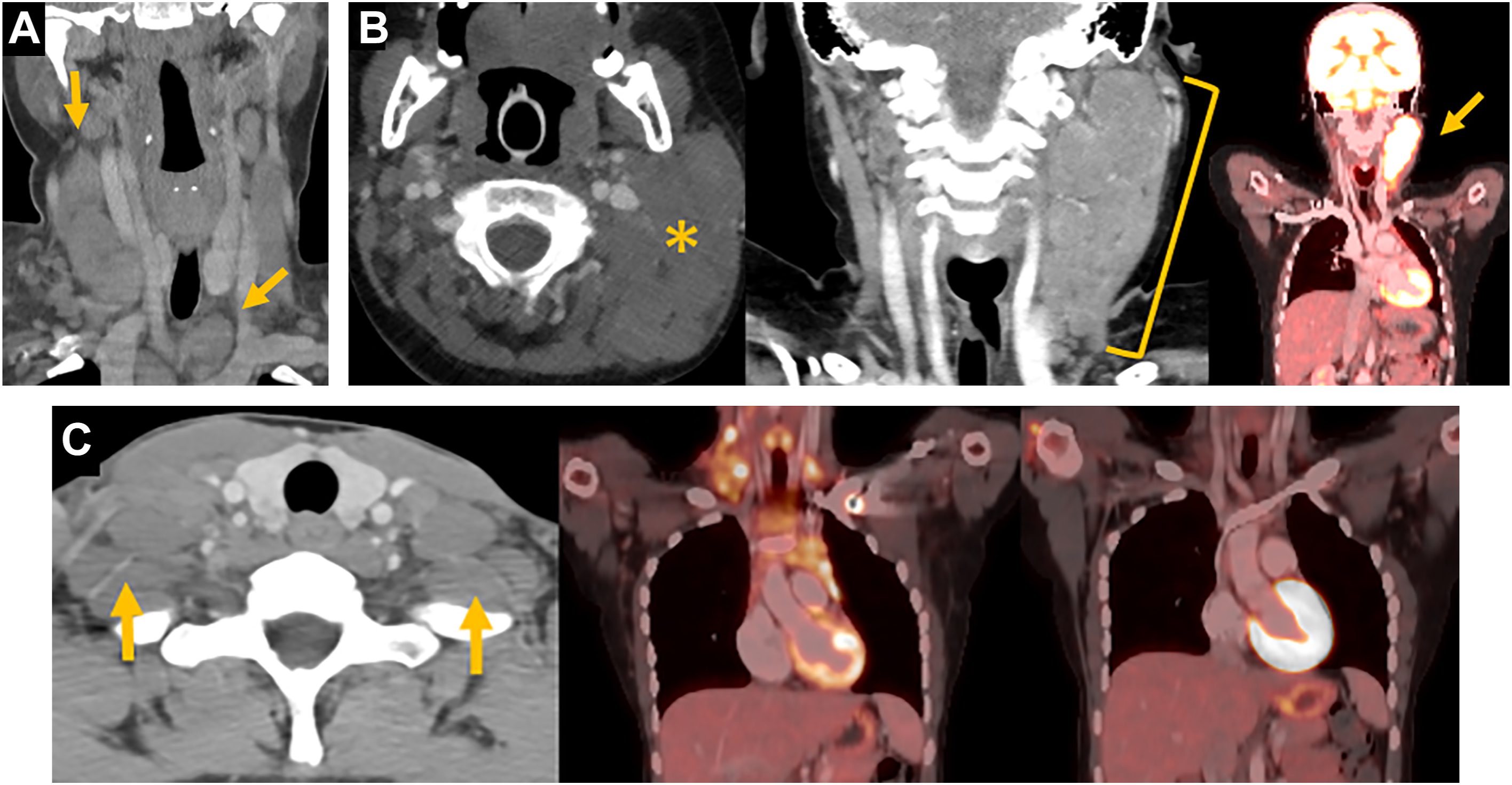 A multipanel display of C T and P E T or C T scans shows head and neck imaging with arrows and an asterisk highlighting lymphadenopathy and metabolic activity in cervical and supraclavicular regions.