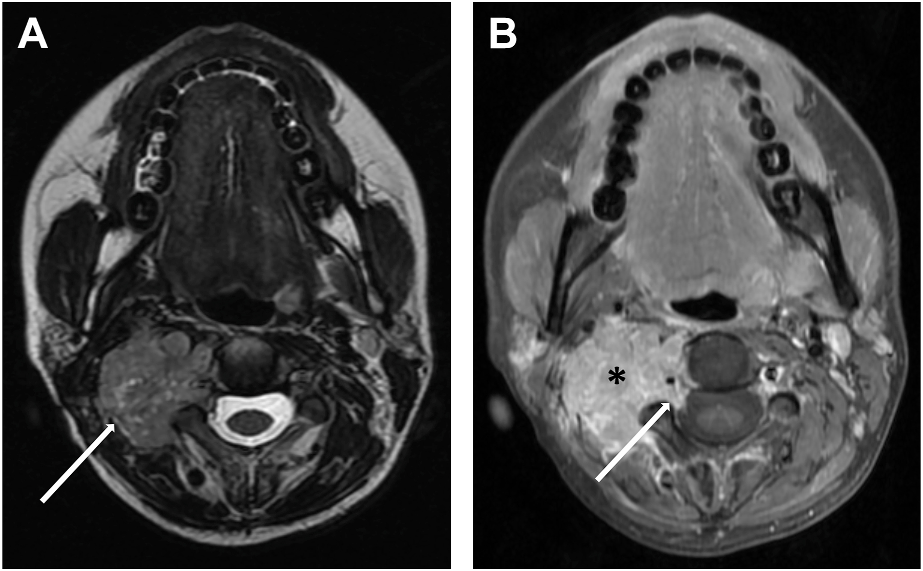Two axial M R I scans of the right neck soft tissue mass with enlargement into the neural foramen.