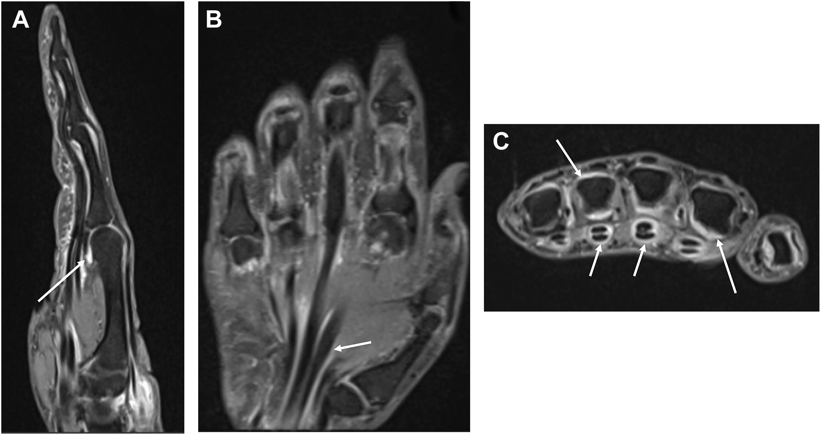 A set of three M R I scans, A, B, and C, shows active morphea-related synovitis in a hand. Arrows in the sagittal, coronal, and axial views mark articular and tendon sheath enhancements.