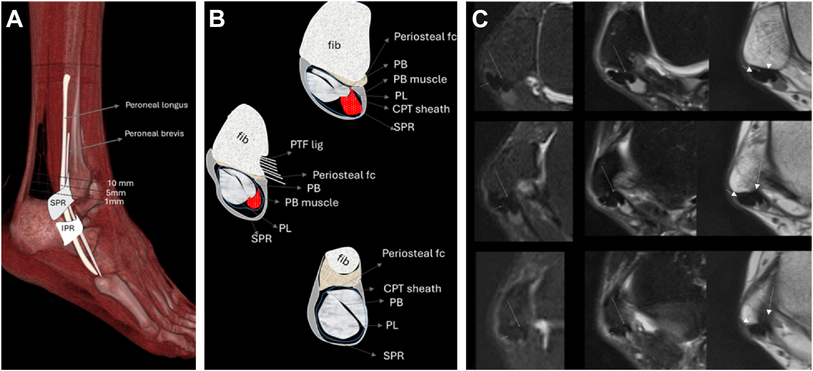 A composite diagram and M R I scans depicting anatomy and structures of the ankle and surrounding tendons.