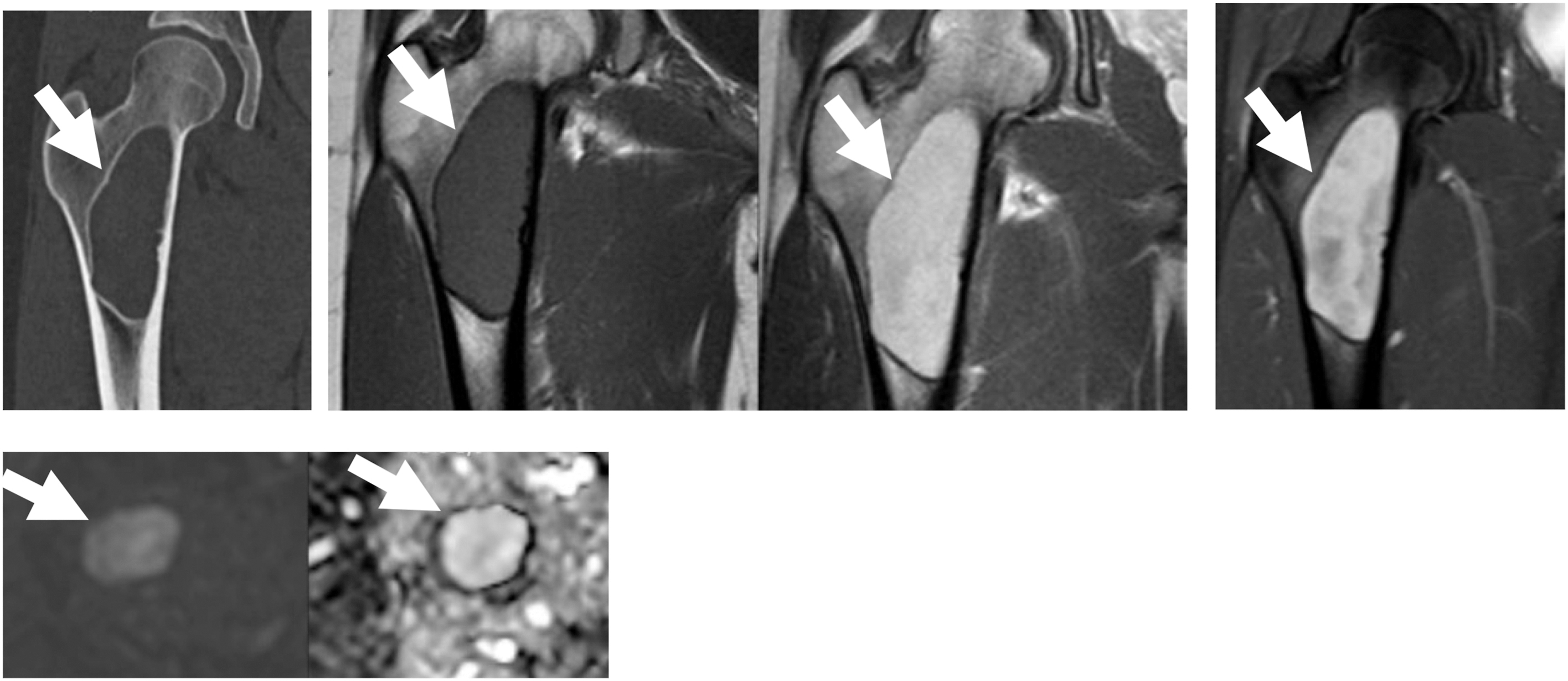 A six-panel set of C T, T one W, T two W, D W I, and A D C scans shows a well defined geographic lesion in a young person, consistent with fibrous dysplasia.