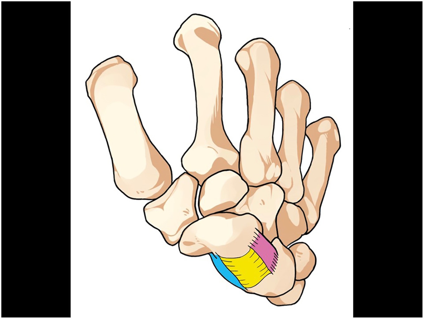A medical illustration of the bones of the hand and wrist with colored ligaments.
