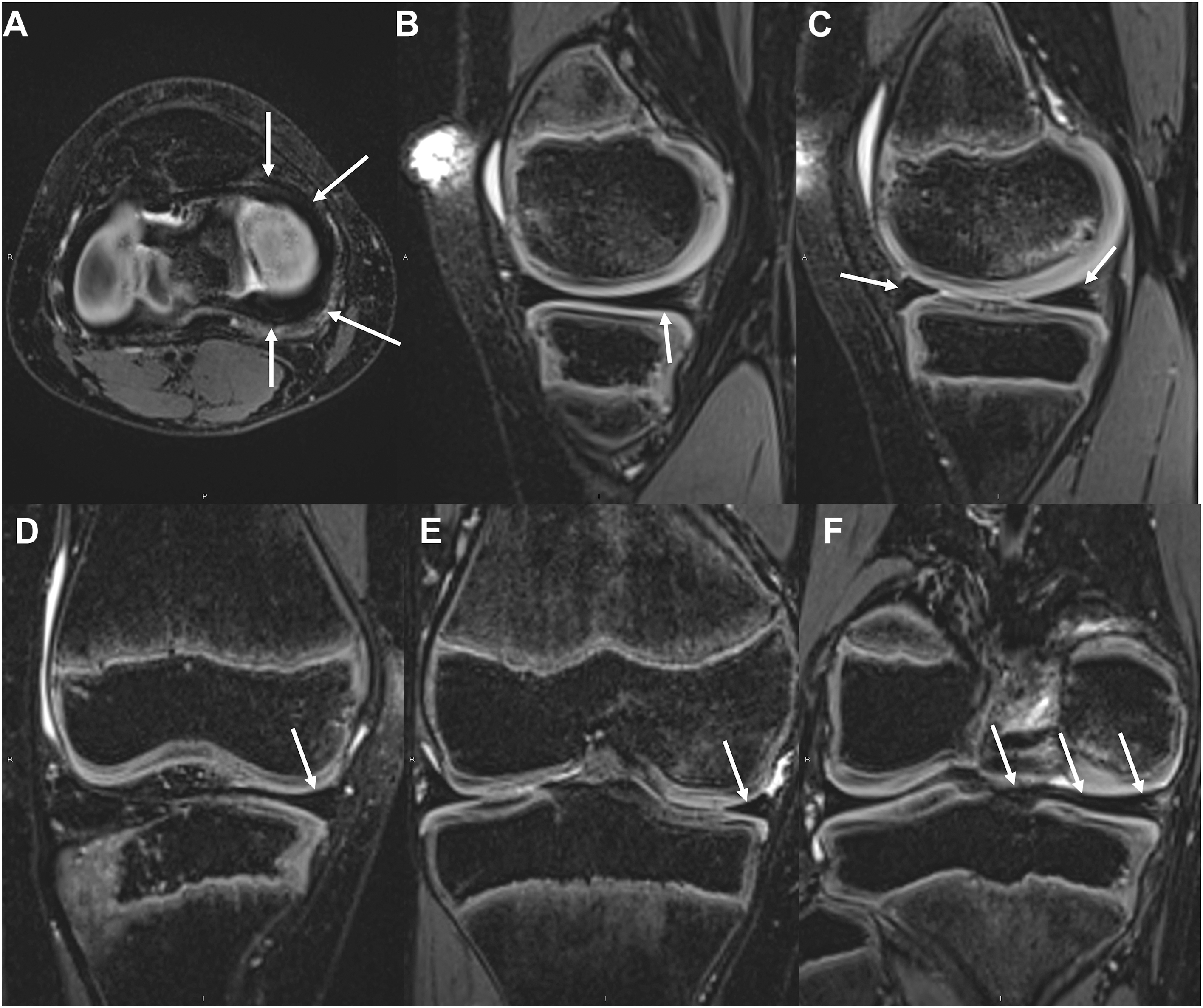 A six-panel, 3 D M R I of a knee shows a normal C-shaped medial meniscus. White arrows in the axial, sagittal, and coronal views point to the normal structure.