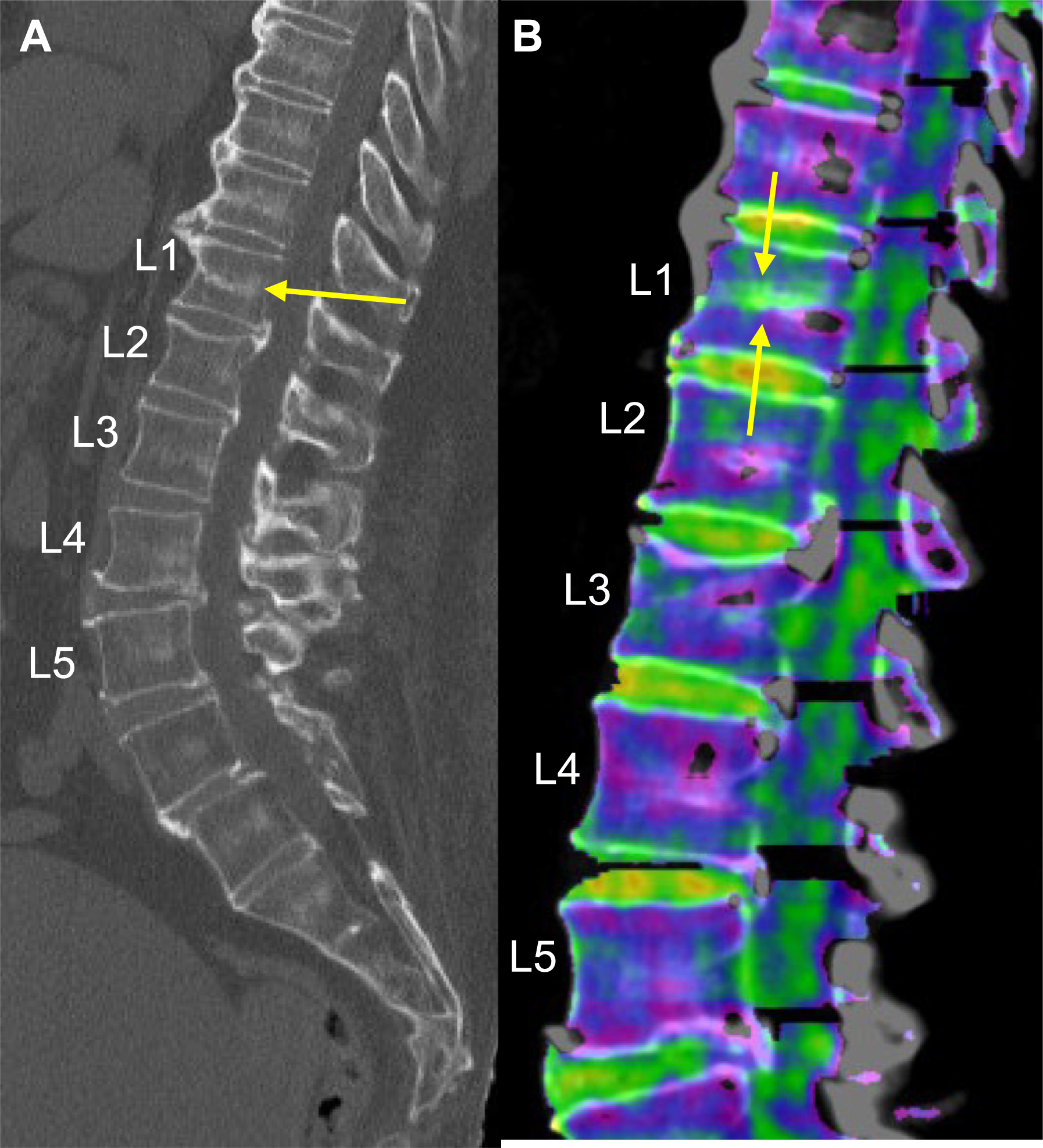 Two sagittal spine images labeled A and B with arrows pointing to the L1 vertebral compression fracture.