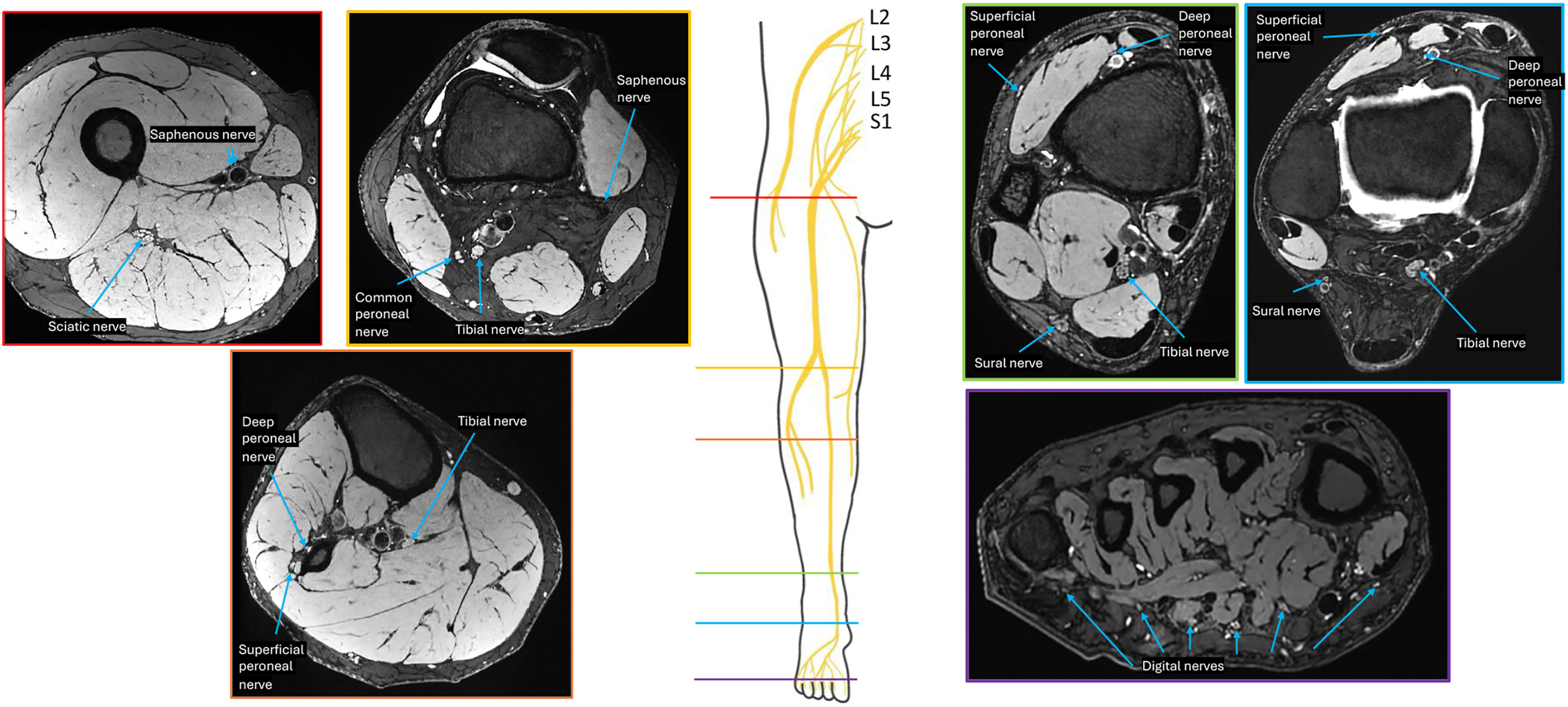 A set of scans shows the normal M R neurography appearance and anatomical course of key lower extremity nerves, from the upper thigh down to the foot, cross-referenced with a central diagram.