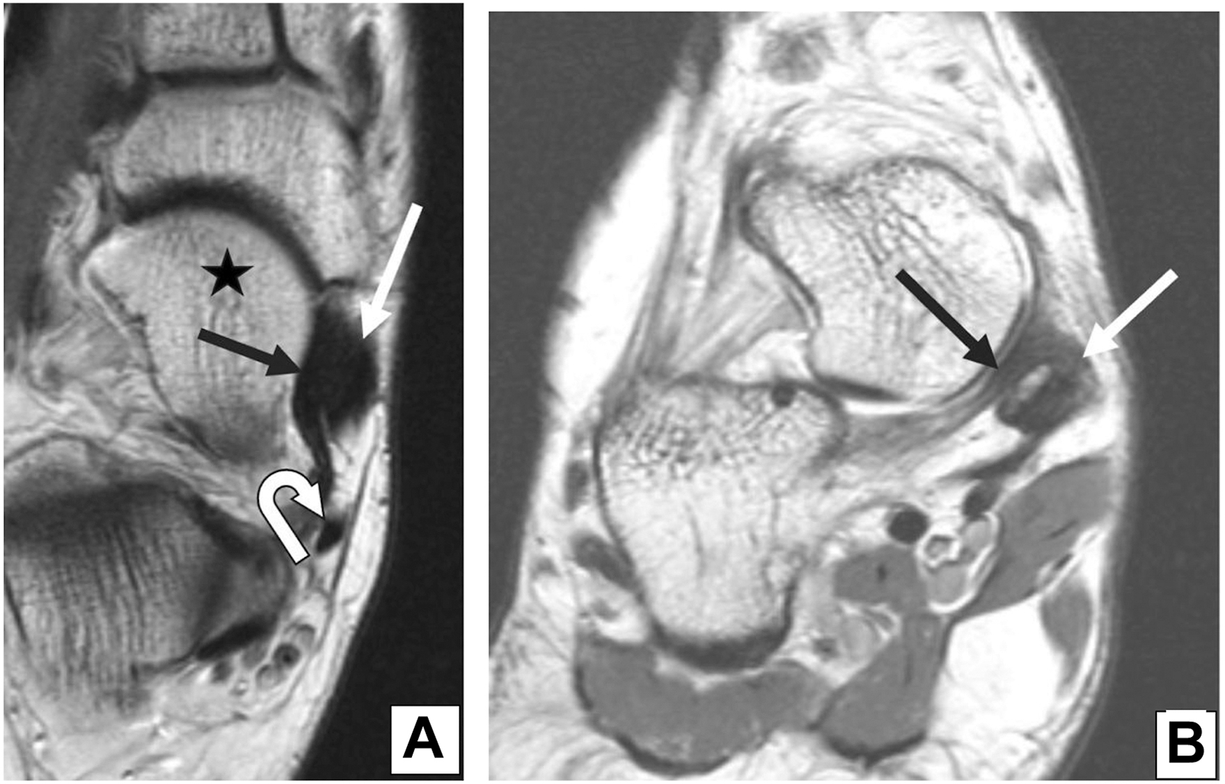 A set of two P D M R I scans, And B, shows a normal posterior tibialis tendon. The axial (A) and coronal (B) views show the p t t, spring ligament, and talus, marked by arrows and an asterisk.