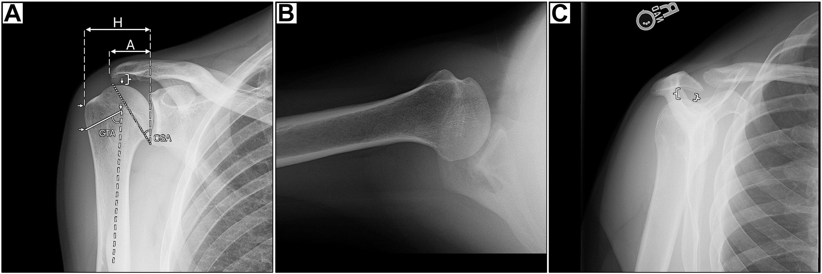 A three-panel radiograph, a, b, and c, shows a routine evaluation of the right shoulder, detailing the acromiohumeral interval, acromion index, critical shoulder angle, and greater tuberosity angle.