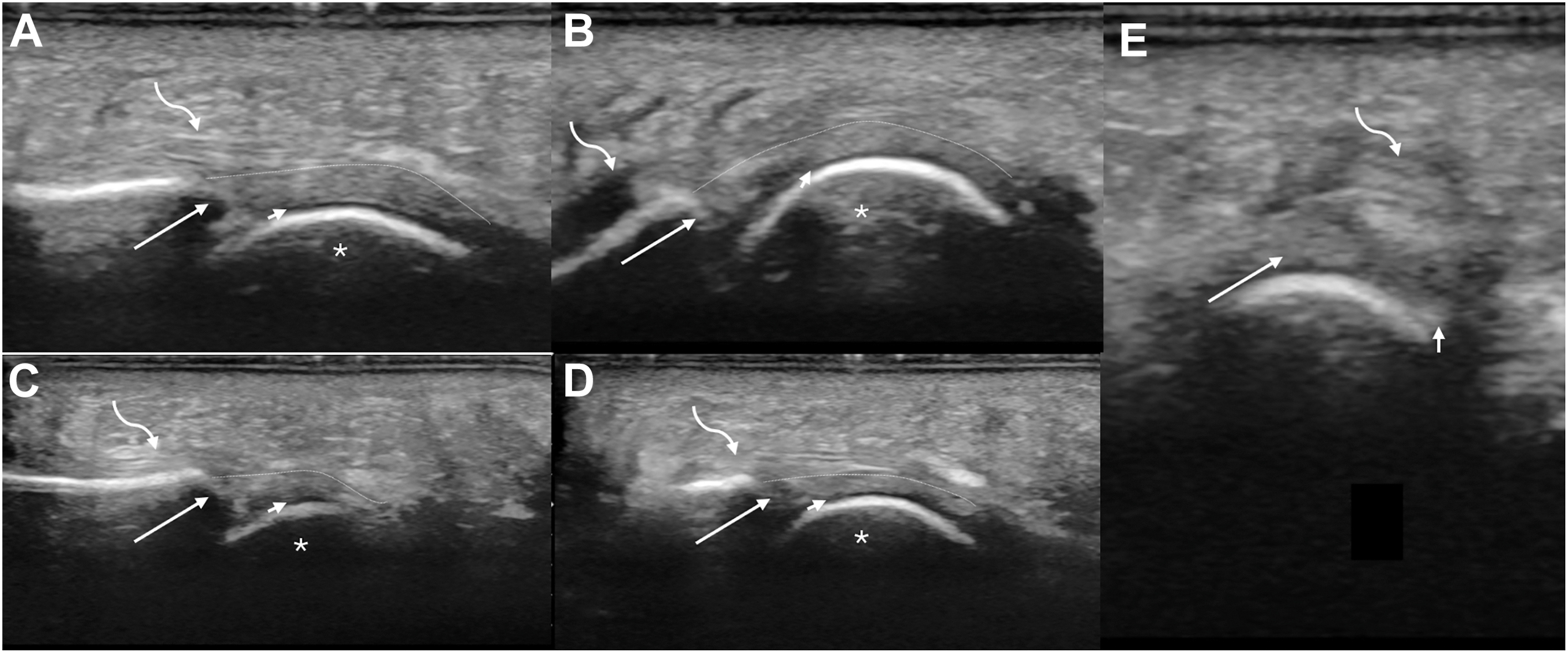 A five-panel ultrasound scan shows the normal appearance of a plantar plate in sagittal views A through D and a transverse view in panel E, with arrows marking the key structures.