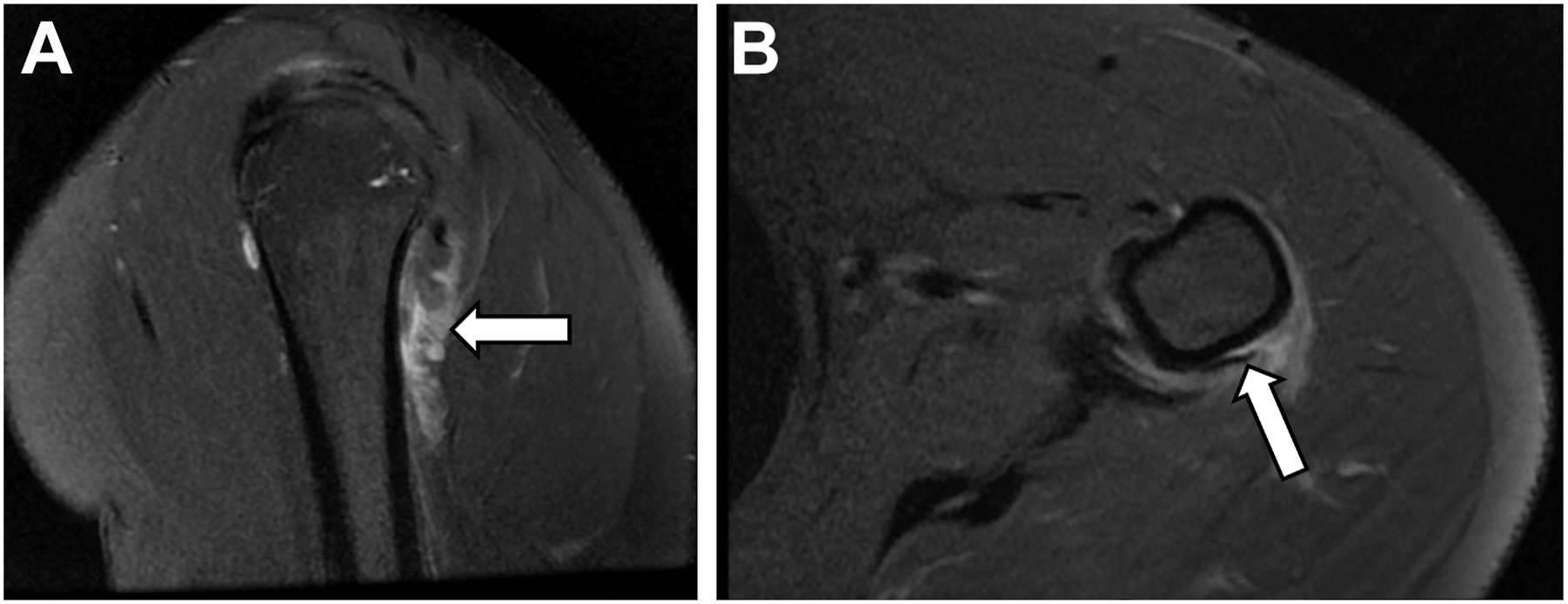 Two M R I shoulder view showing abnormal tendon separation with visible tearing near the junction and swelling around soft tissues.
