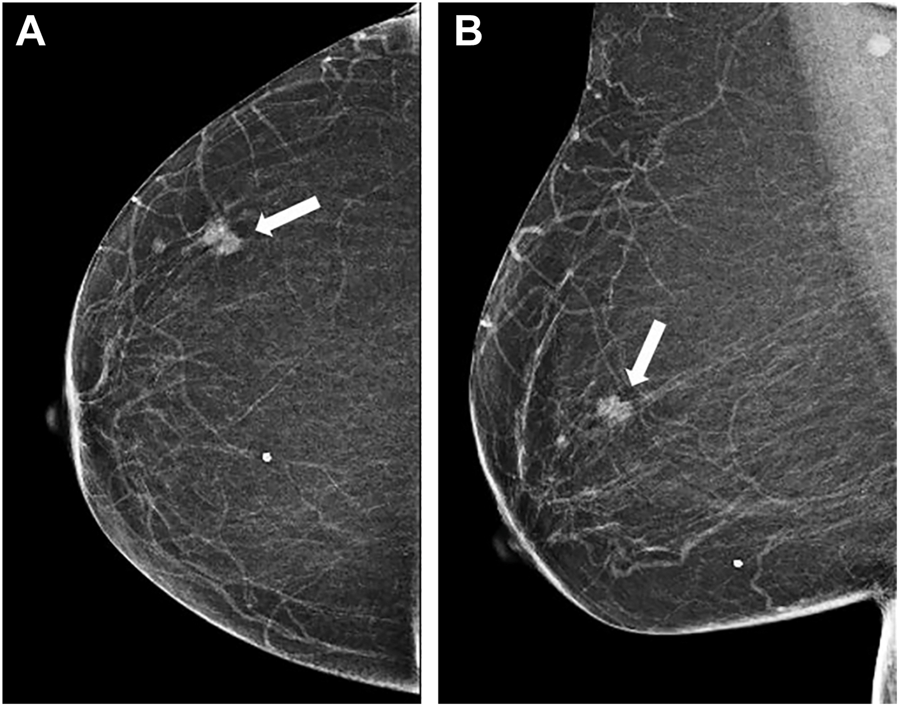 A two-panel mammogram of the right breast in C C and M L O views shows a dense, irregular 1.4-centimeter mass in the upper outer quadrant marked with arrows.