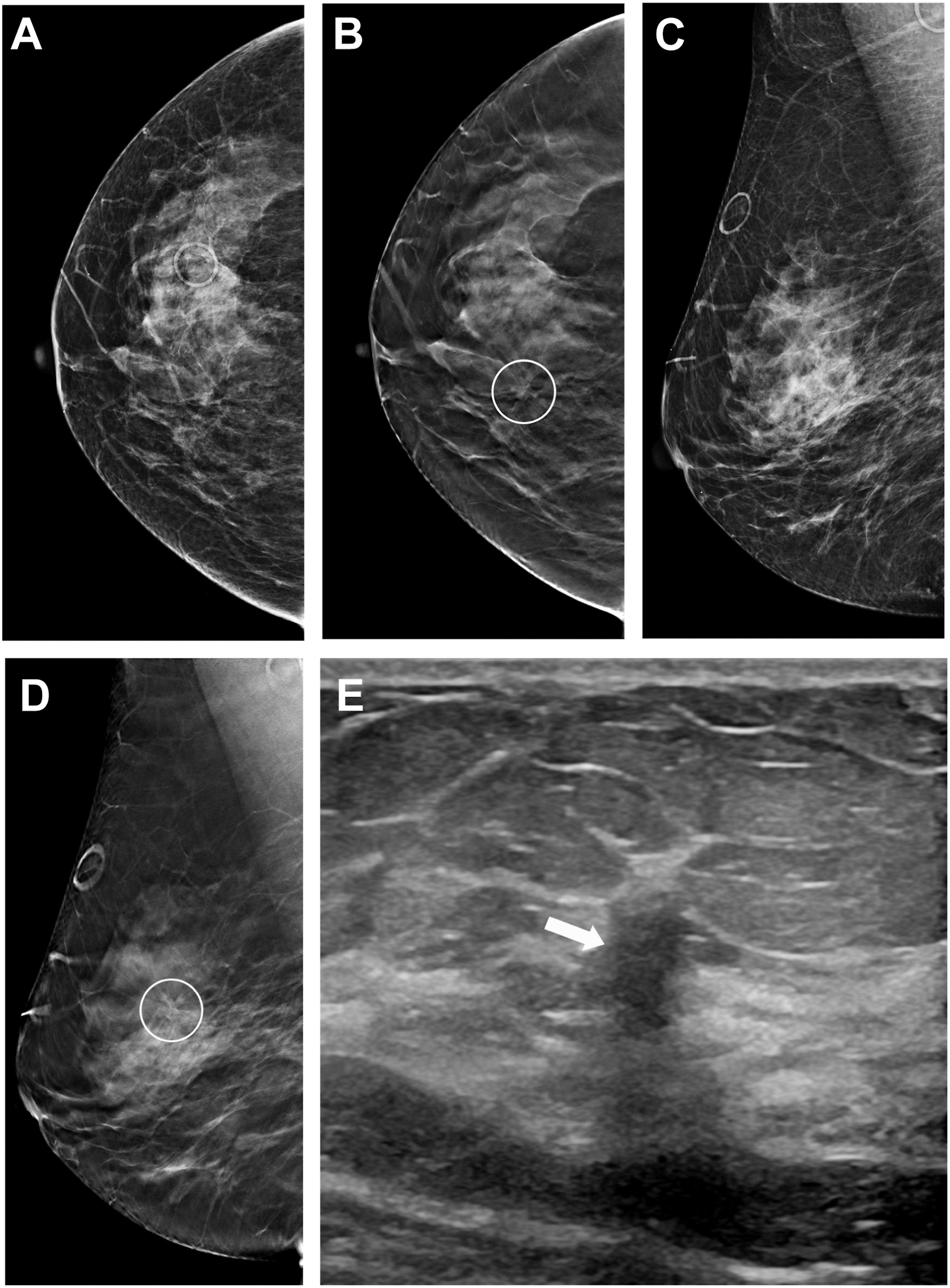 Five panels show a screening mammography, digital breast tomosynthesis, and ultrasound, which identified invasive ductal carcinoma in a 51-year-old patient.