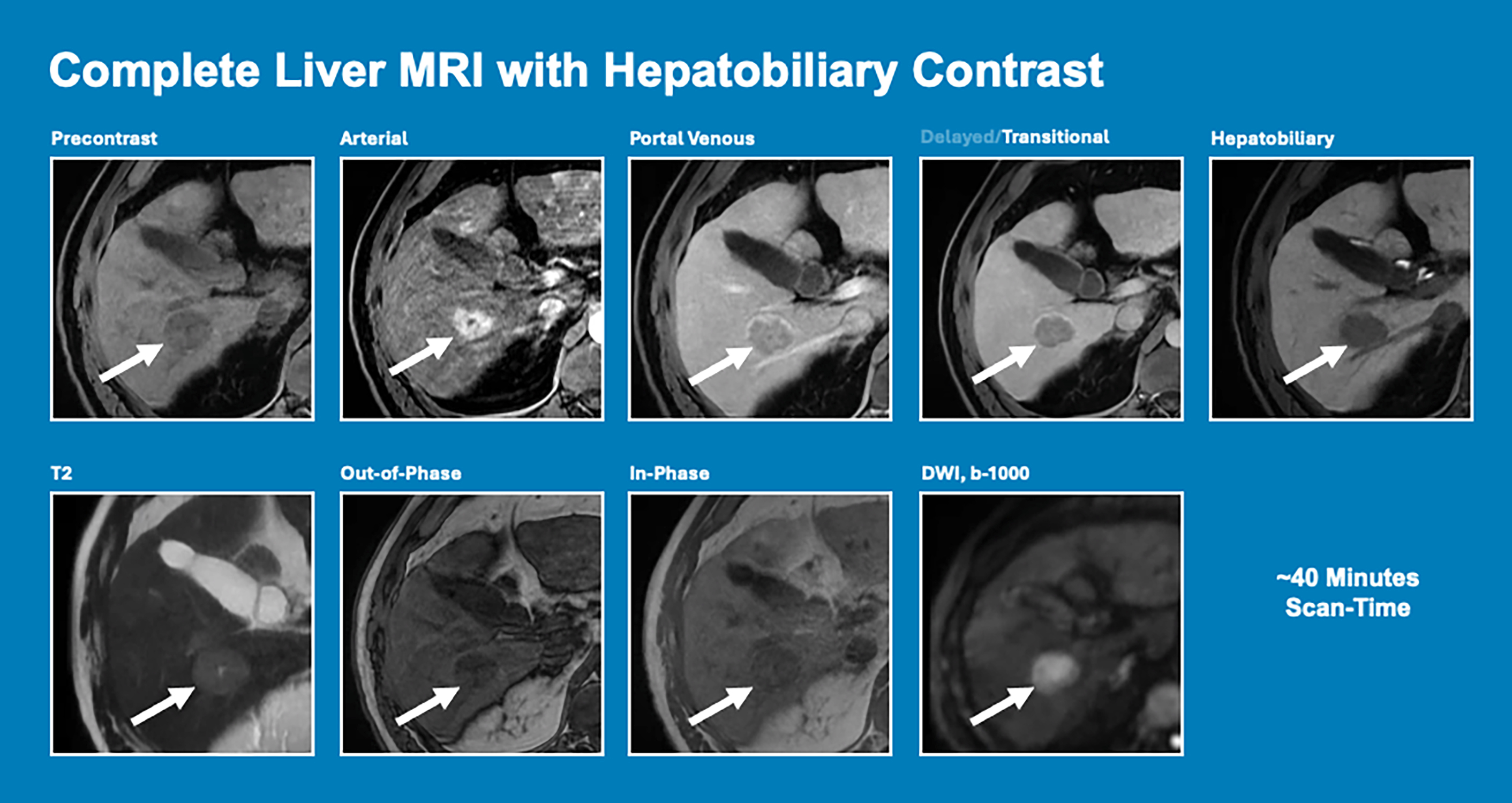 Nine panels show a complete liver M R I with hepatobiliary contrast with a focal lesion across various phases, including arterial, venous, and delayed transitional.