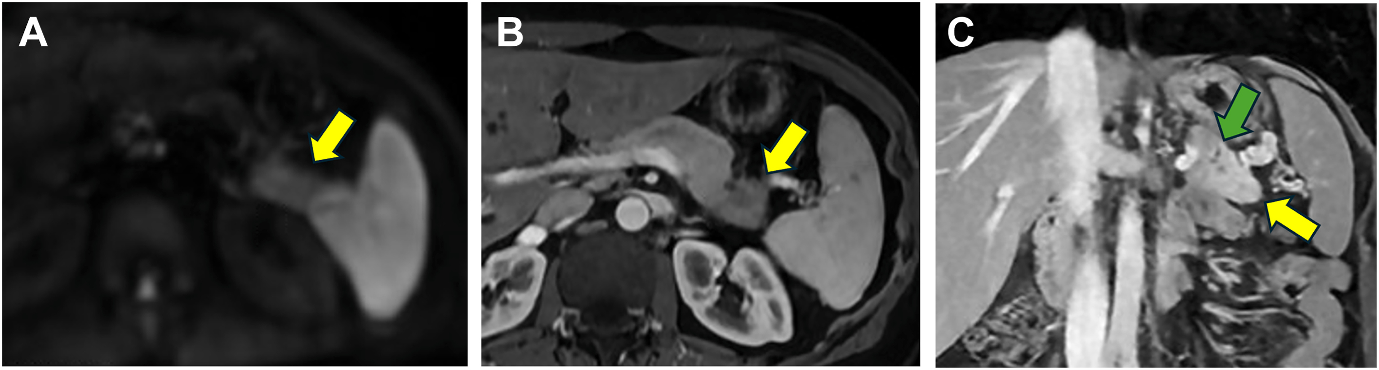 A three-panel abdominal MRI of a 52-year-old female with pancreatic cancer shows an ill-defined lesion and focal duct aberrations in the pancreatic tail, where there was prior pancreatitis.