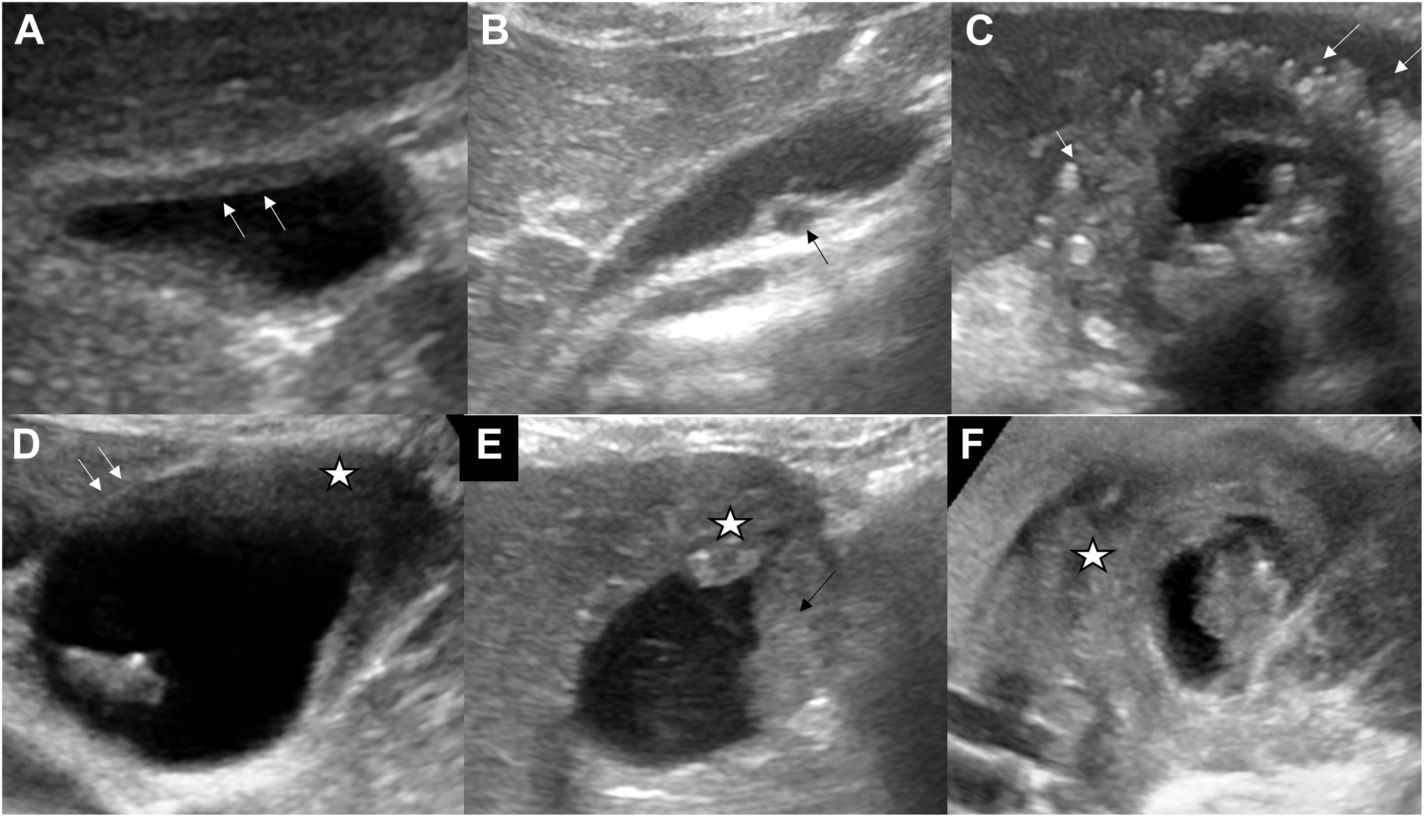 Six ultrasound panels show gallbladder wall thickening patterns with mural layering, intramural cysts, echogenic foci, and liver interface features categorized by G B-R A D S.