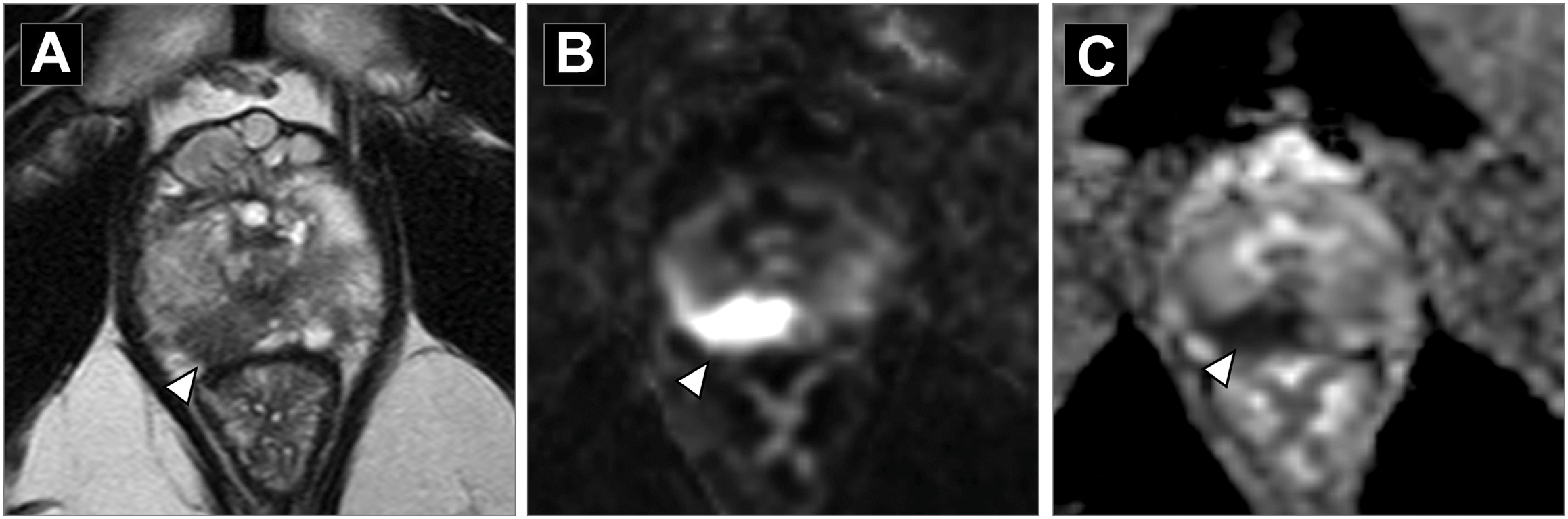 Three axial prostate M R I shows a focal right peripheral zone lesion with abnormal signal on T 2-weighted, diffusion-weighted, and apparent diffusion coefficient map.