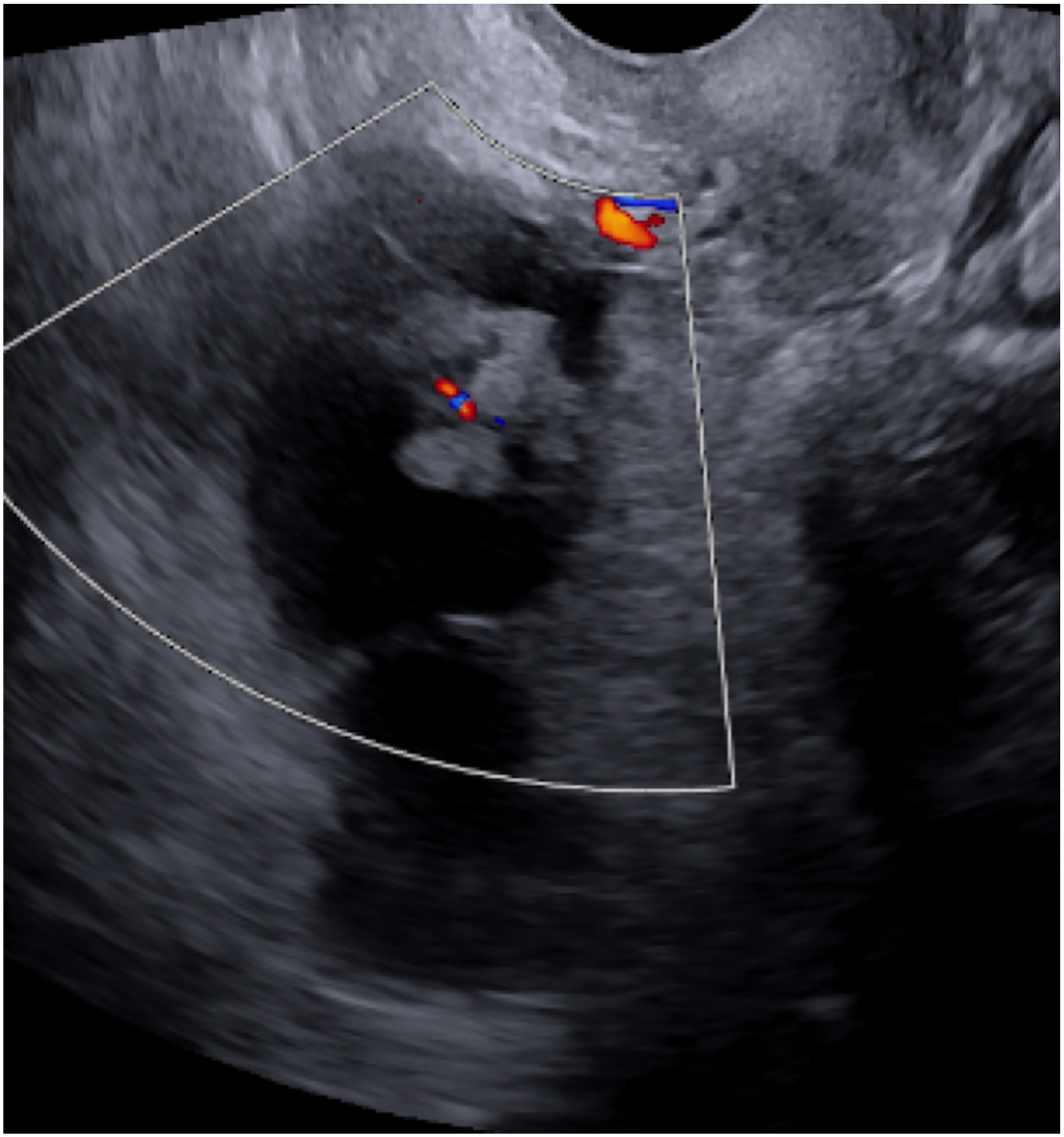 A transvaginal pelvic ultrasound with color Doppler shows a 7-centimeter multilocular cystic mass in the right adnexa of a 73-year-old patient, later diagnosed as high-grade serous carcinoma.