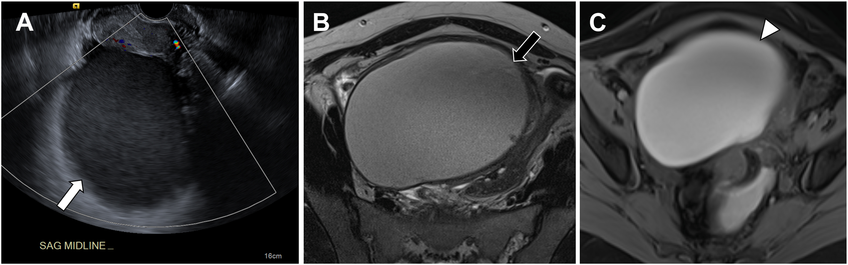Three panels with a left ovarian endometrioma show an avascular, homogeneously hypoechoic cyst with low-level internal echoes on transvaginal ultrasound and T 1, T 2 dark of the cyst contents.