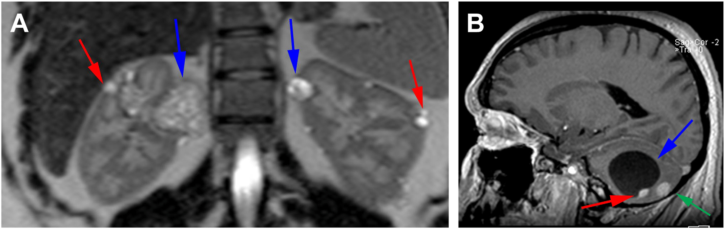 A coronal kidney M R I and sagittal brain M R I demonstrates bilateral renal tumors and cysts with cerebellar hemangioblastomas in a patient with von Hippel-Lindau disease.