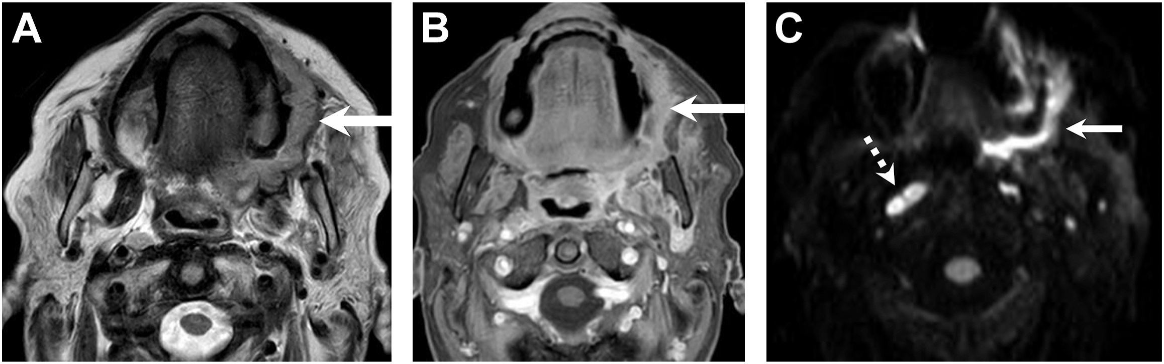 A set of three axial head M R I scans displays with solid colored arrows pointing to a mass-like lesion in the tongue region across T 1, contrast, and diffusion-weighted views.