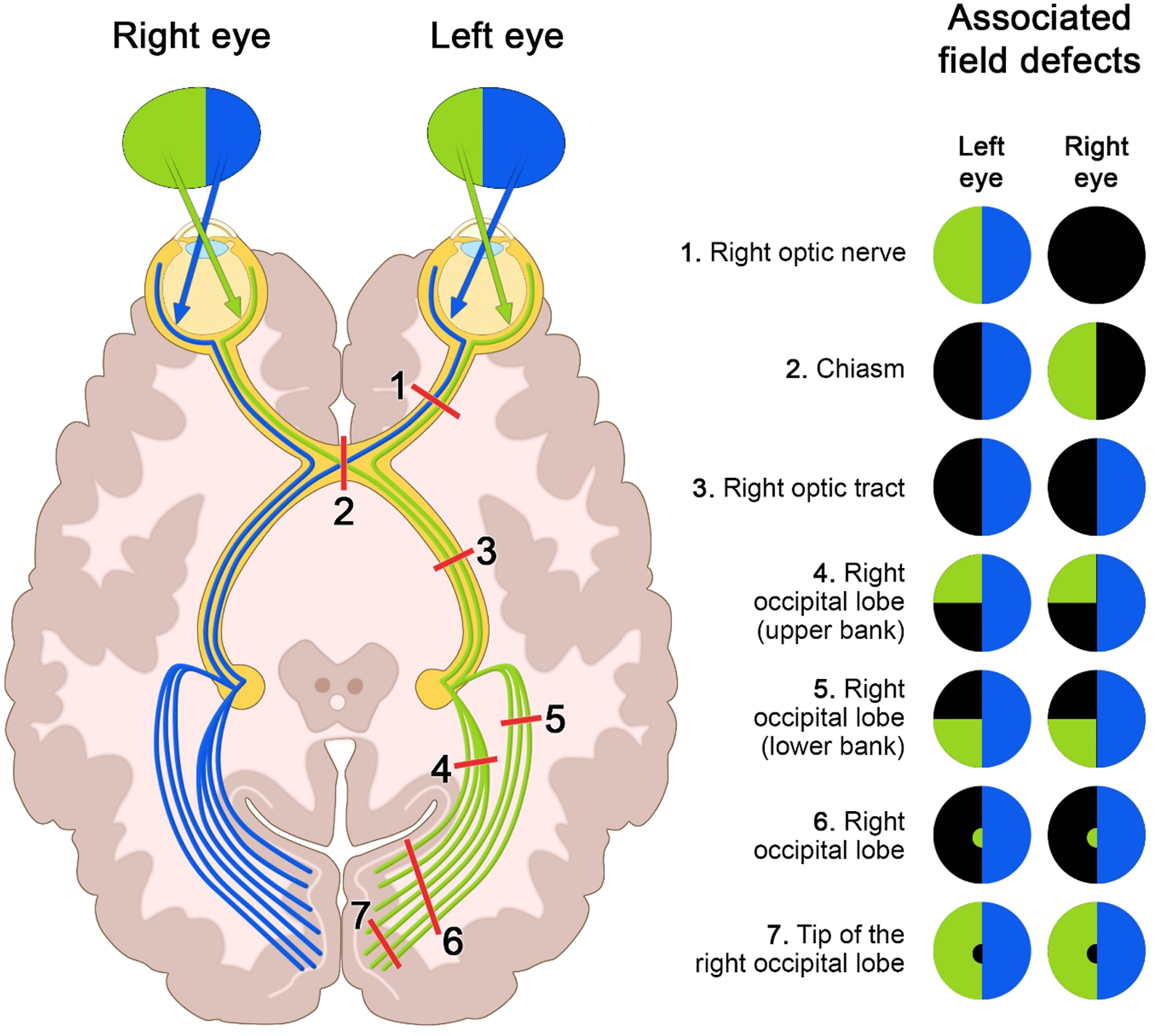 A diagram of the visual pathway from both eyes to the occipital cortex, with seven numbered lesion sites and their corresponding associated field defects for the left and right eye.