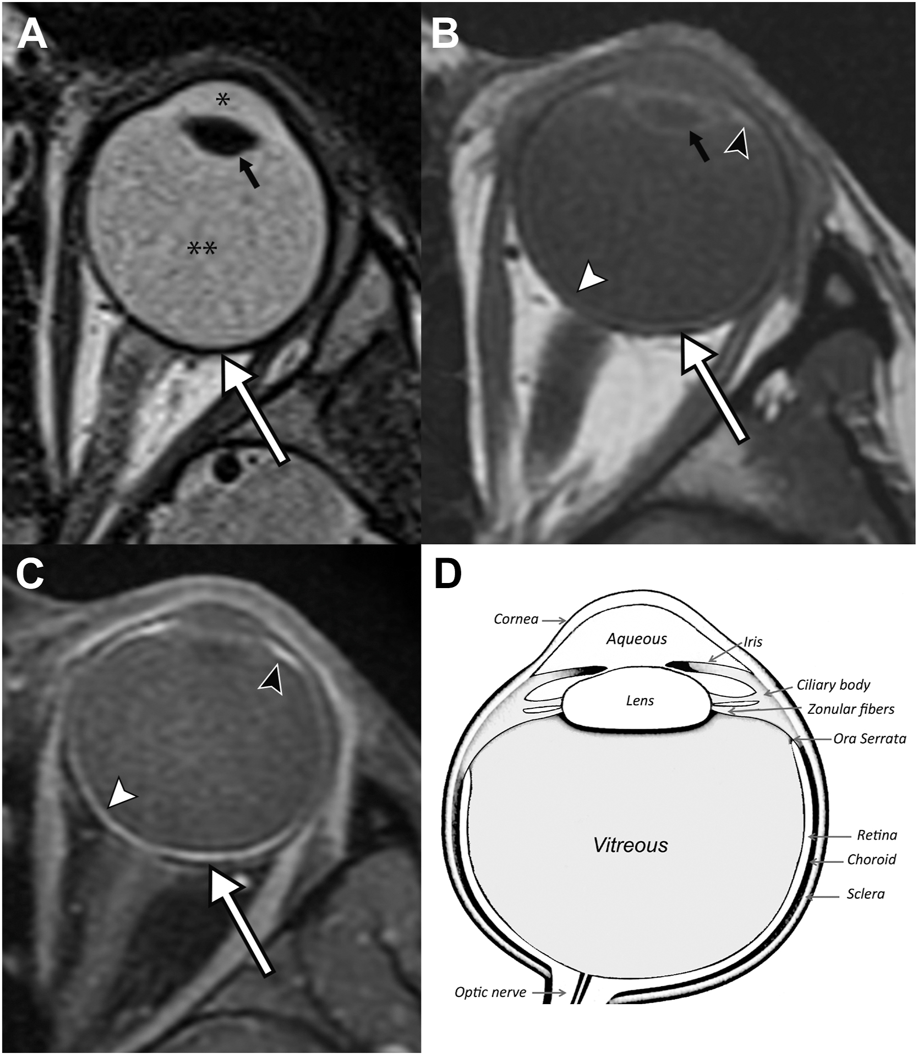 Four panels depict M R I images of the eye in axial T2, T1, and contrast-enhanced T1 views, with labeled structures of the globe, and an accompanying schematic diagram of ocular anatomy.