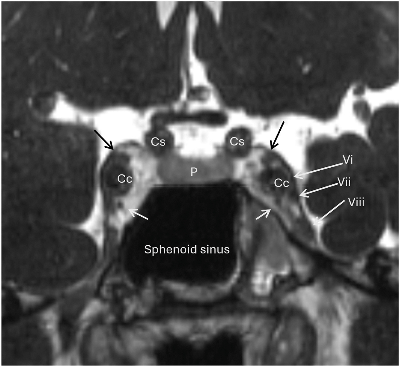 A coronal contrast-enhanced C I S S M R I shows the cavernous sinus anatomy, including the pituitary gland, internal carotid arteries, and cranial nerves surrounding the central sphenoid sinus.