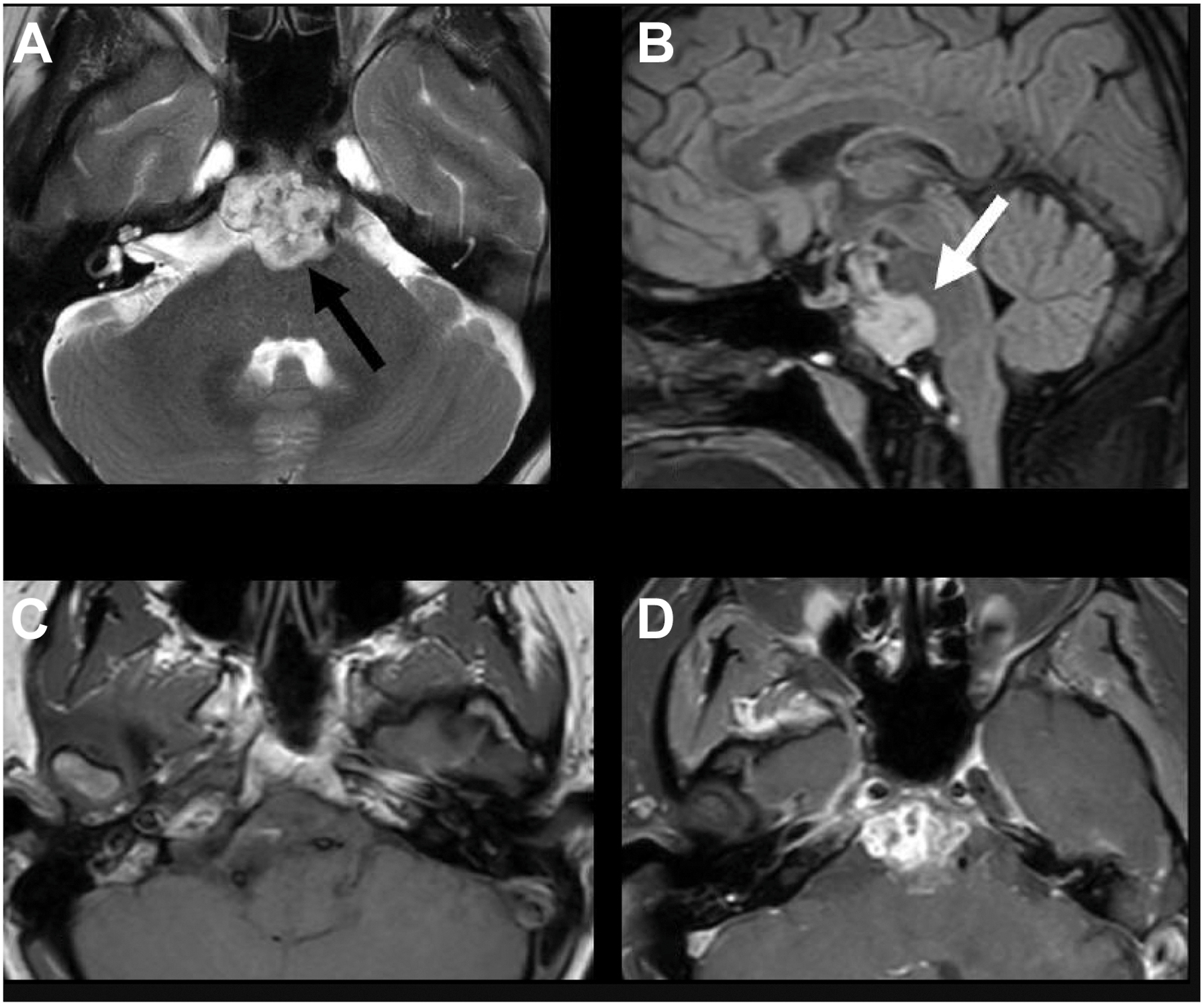 A four-panel brain M R I shows a chordoma with T 2-weighted and T 1-pre and post-contrast scans revealing a lobulated, enhancing midline mass extending into the prepontine cistern.