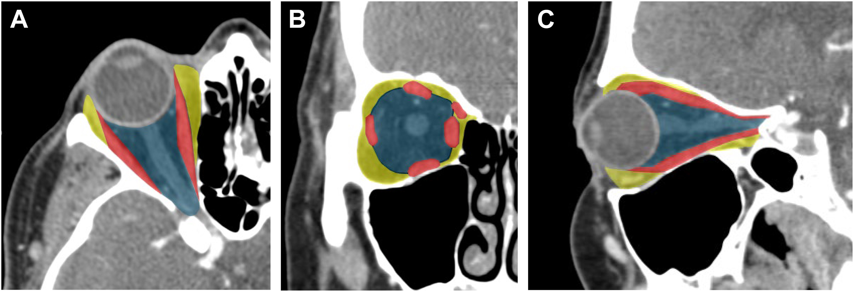 A set of orbital anatomy computed tomography scans in axial, coronal, and sagittal views features color overlays that highlight the intraconal, extraocular, and extraconal spaces.