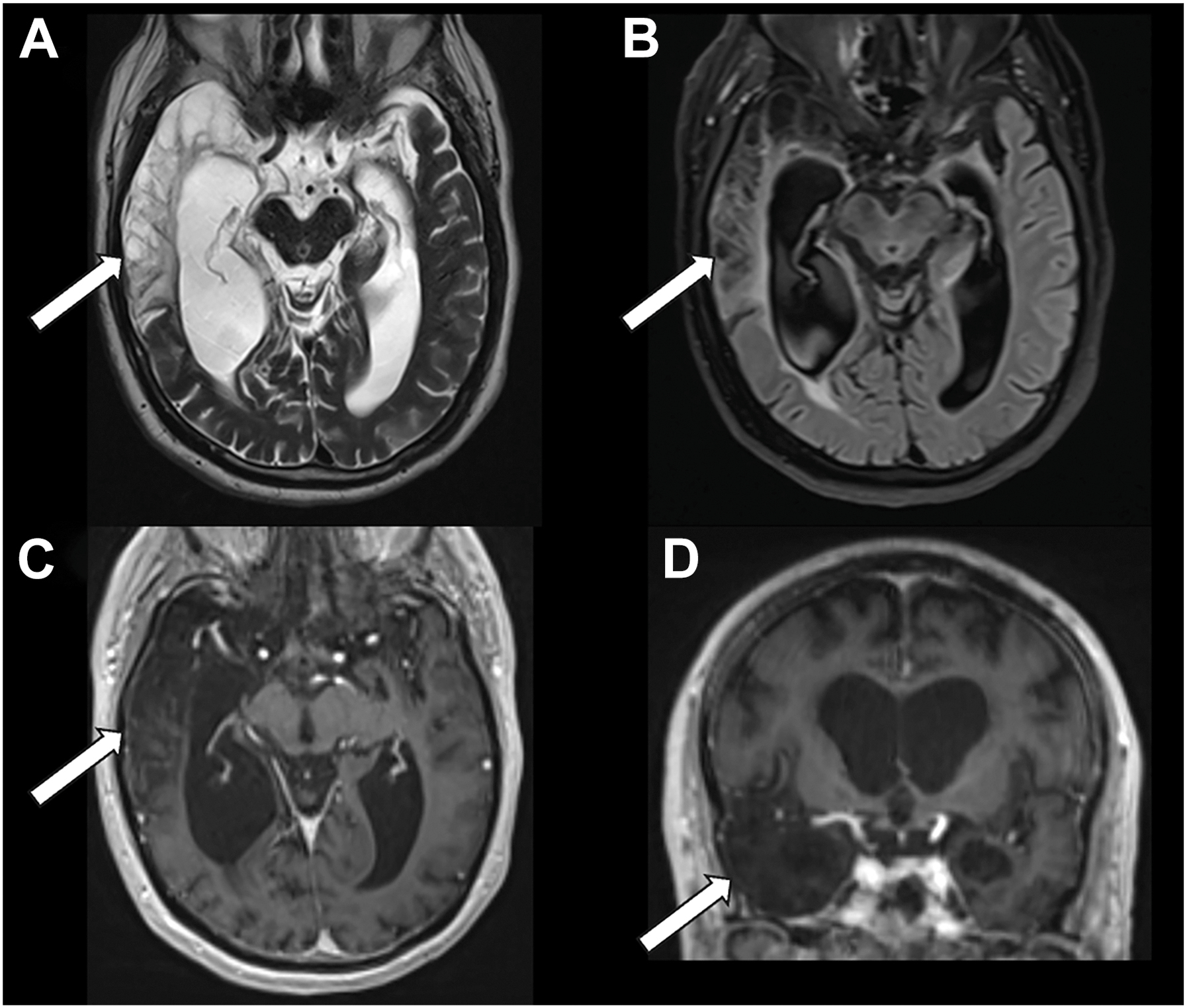 A four-panel brain magnetic resonance imaging scan shows sequela of herpes simplex virus encephalitis involving optic radiations in the right temporal lobe, highlighted by arrows.