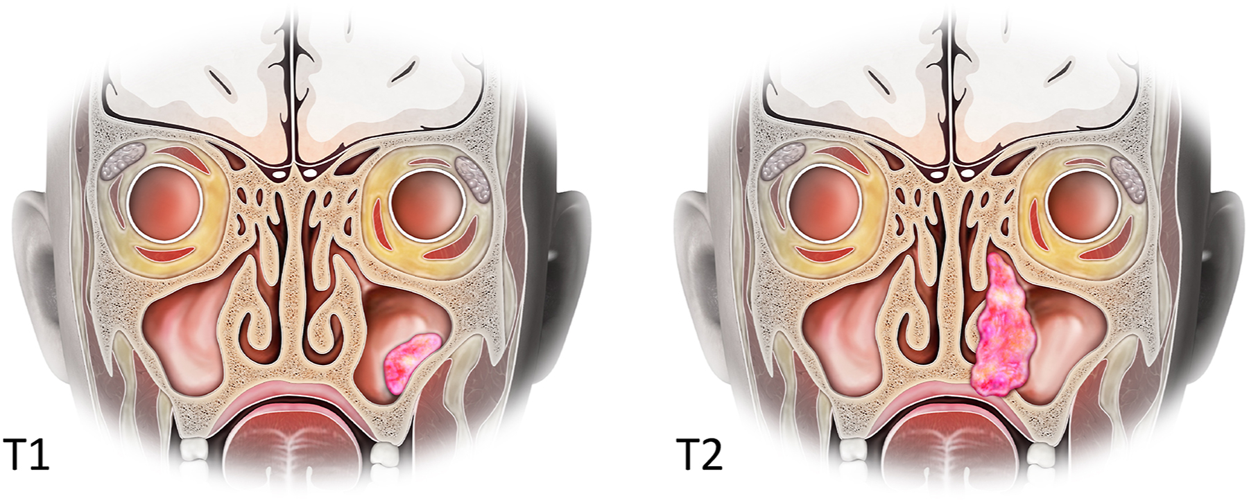 A labeled diagram shows coronal views of the nasal cavity and maxillary sinus in T 1 and T 2 maxillary sinus tumors.
