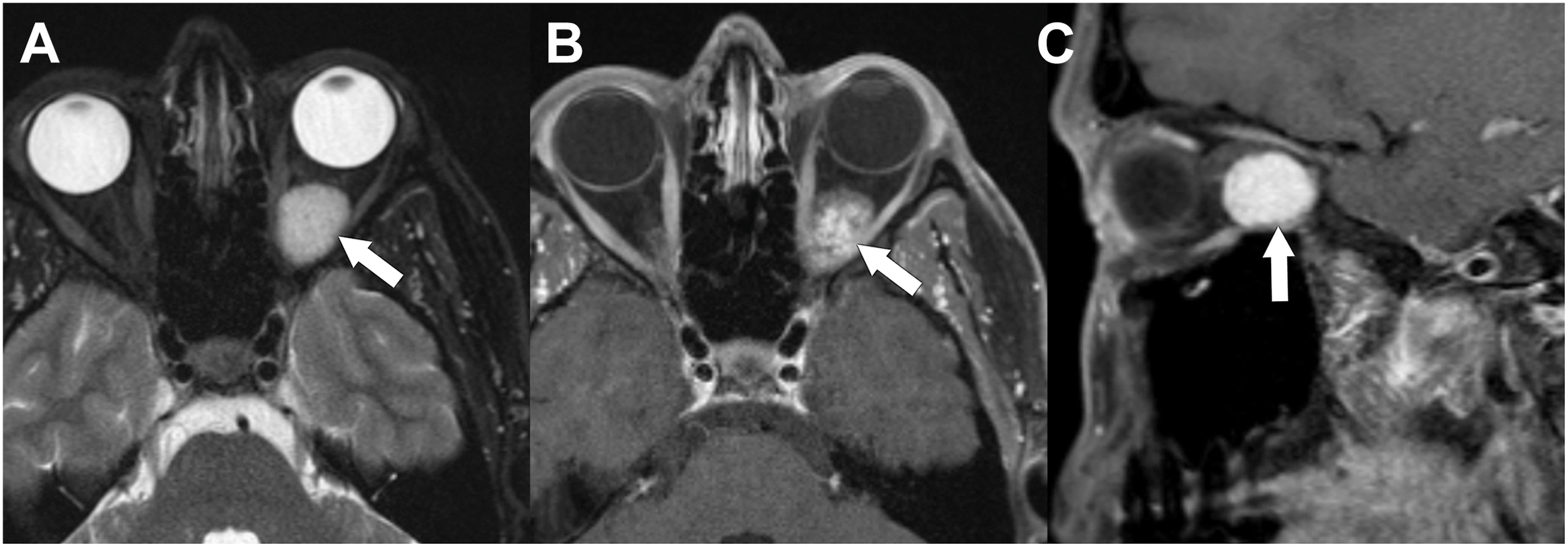 A set of three magnetic resonance imaging scans shows a venous malformation with arrows pointing to a hyperintense intraconal mass on axial and sagittal views, marking a low-flow vascular lesion.