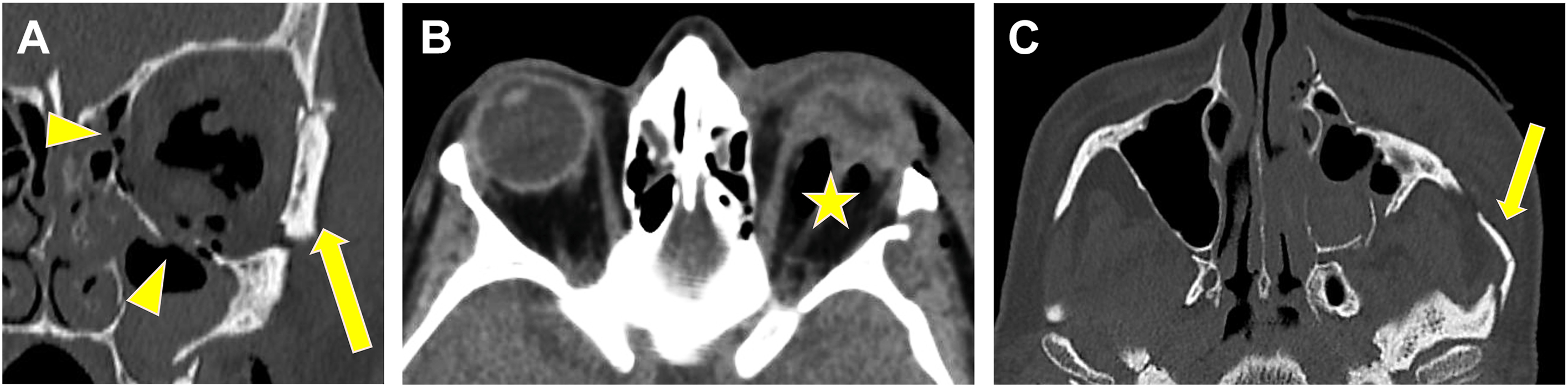 A three-panel computed tomography scan shows a left zygomaticomaxillary complex fracture with globe rupture, indicated by markers pointing to specific bone breaks and flattening.