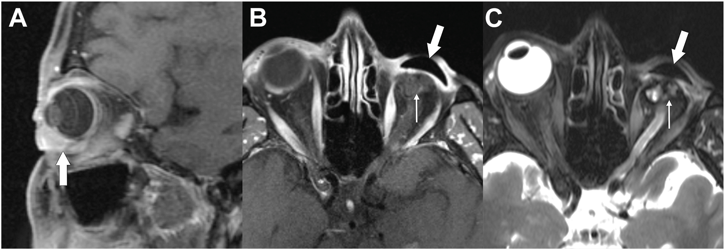 A set of three magnetic resonance imaging scans shows an enhancing conjunctival lesion in a sagittal view and the residual sclera with a prosthesis in axial views following an evisceration.