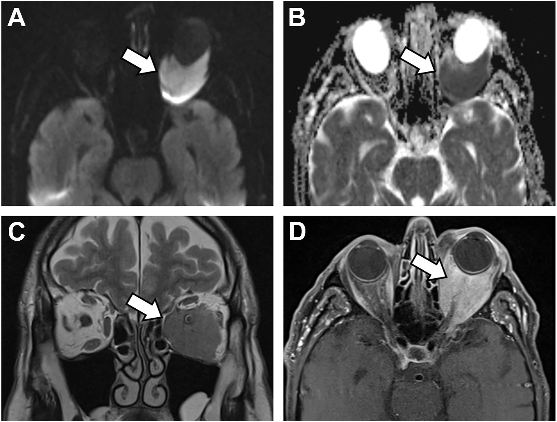 Four M R I images labeled A, B, C, and D of the orbital region illustrate an ocular adnexal lymphoma.