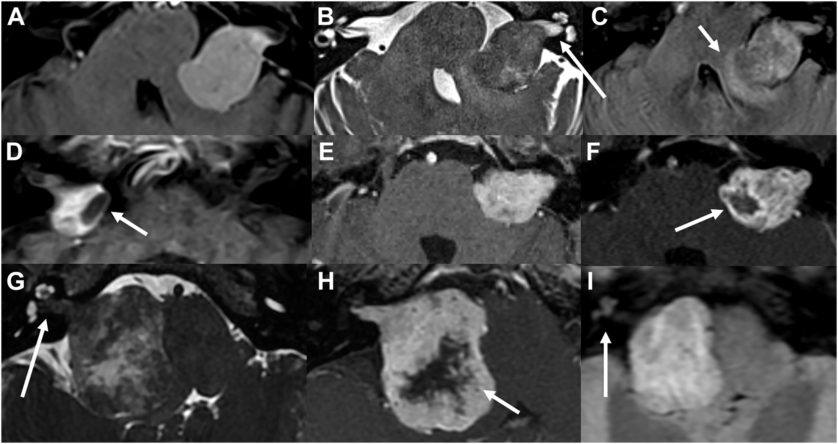 A grid of nine Magnetic Resonance Imaging sequences shows a mass in the auditory canal region extending to the brainstem with cystic change and post-treatment variations.