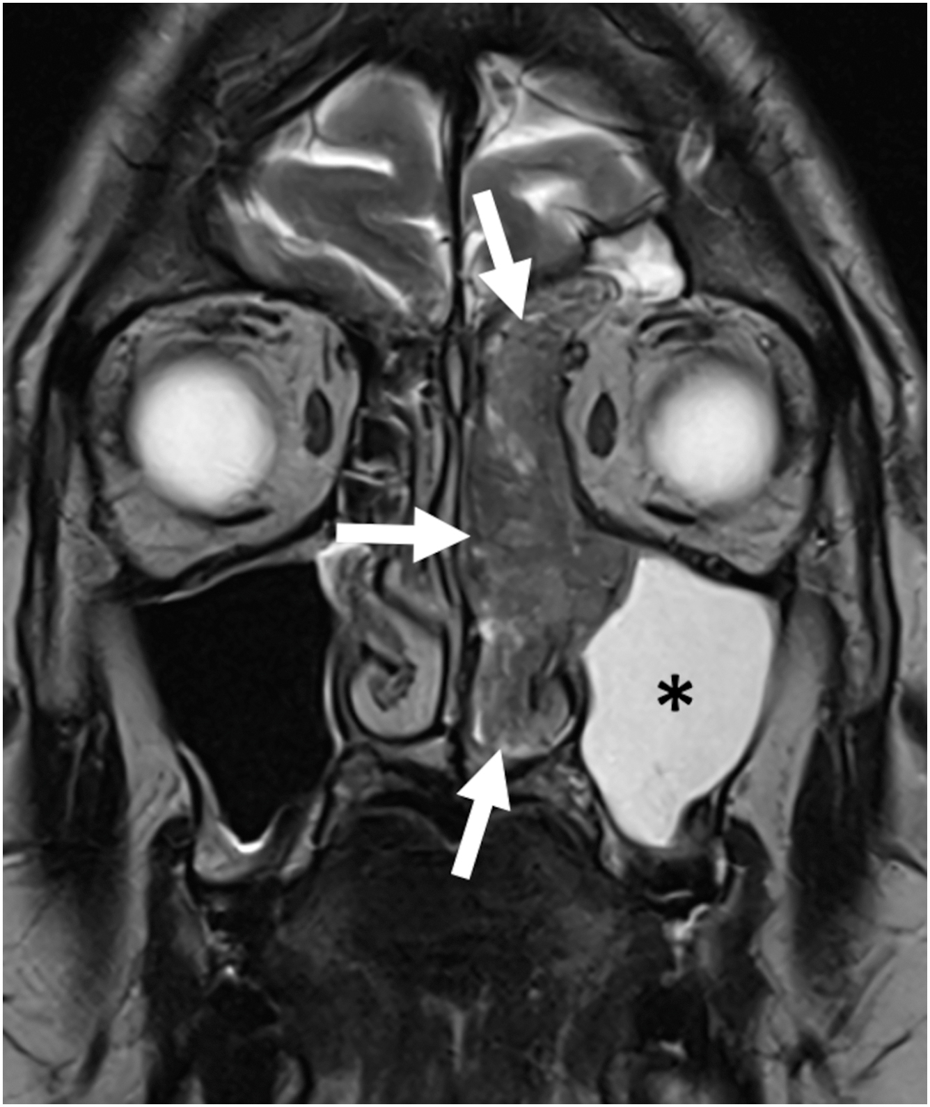 A coronal M R I scan of the face depicts a large mass in the right maxillary sinus marked by an asterisk, and several arrows indicate involvement of adjacent nasal and orbital structures. T2 hypointense mass in the LEFT nasal cavity marked with arrows, and T2 hyperintense obstructed fluid within the LEFT maxillary sinus marked by an asterisk.