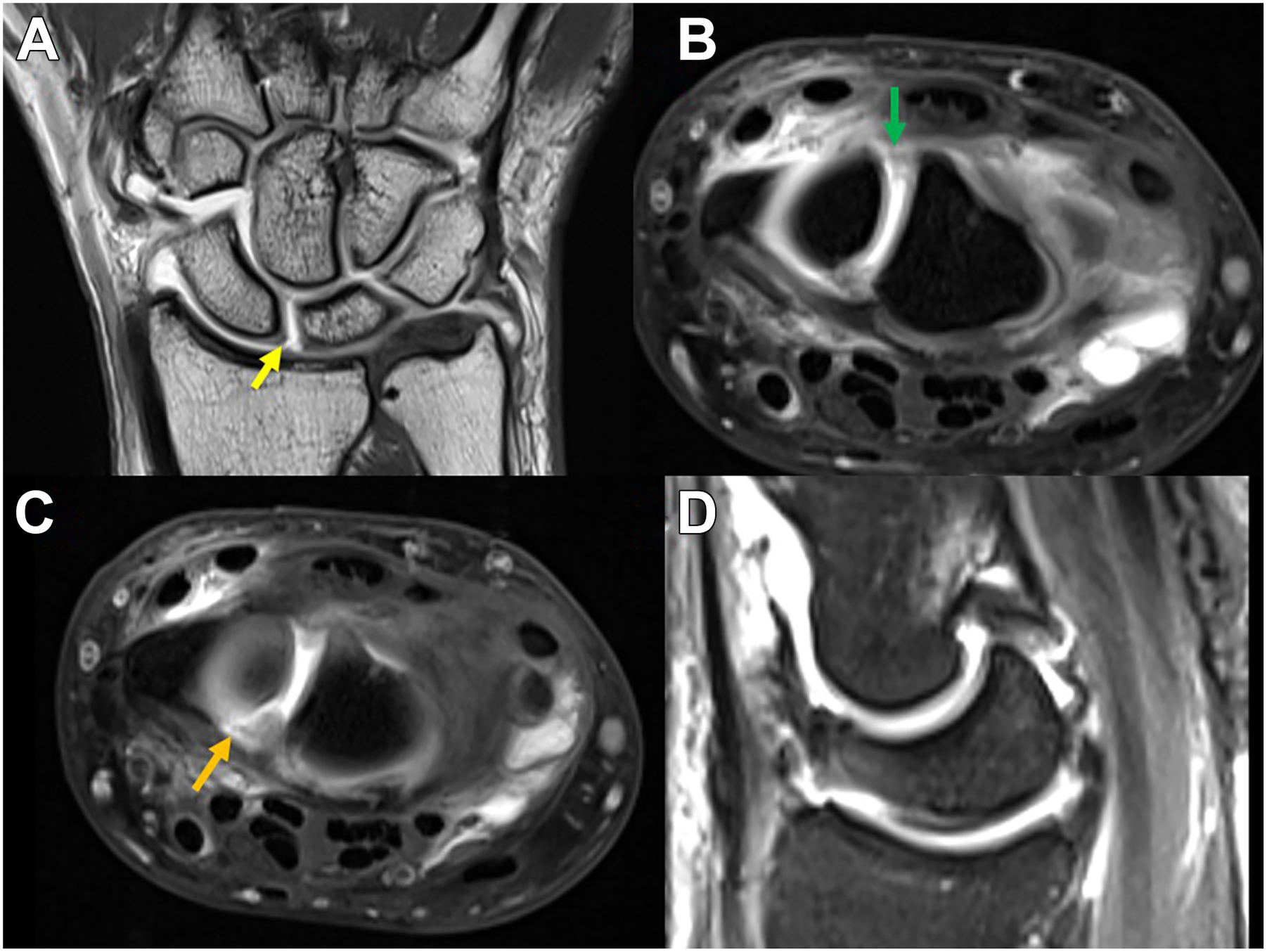 Four M R I scan series of a wrist shows a complete tear of the scapholunate ligament.