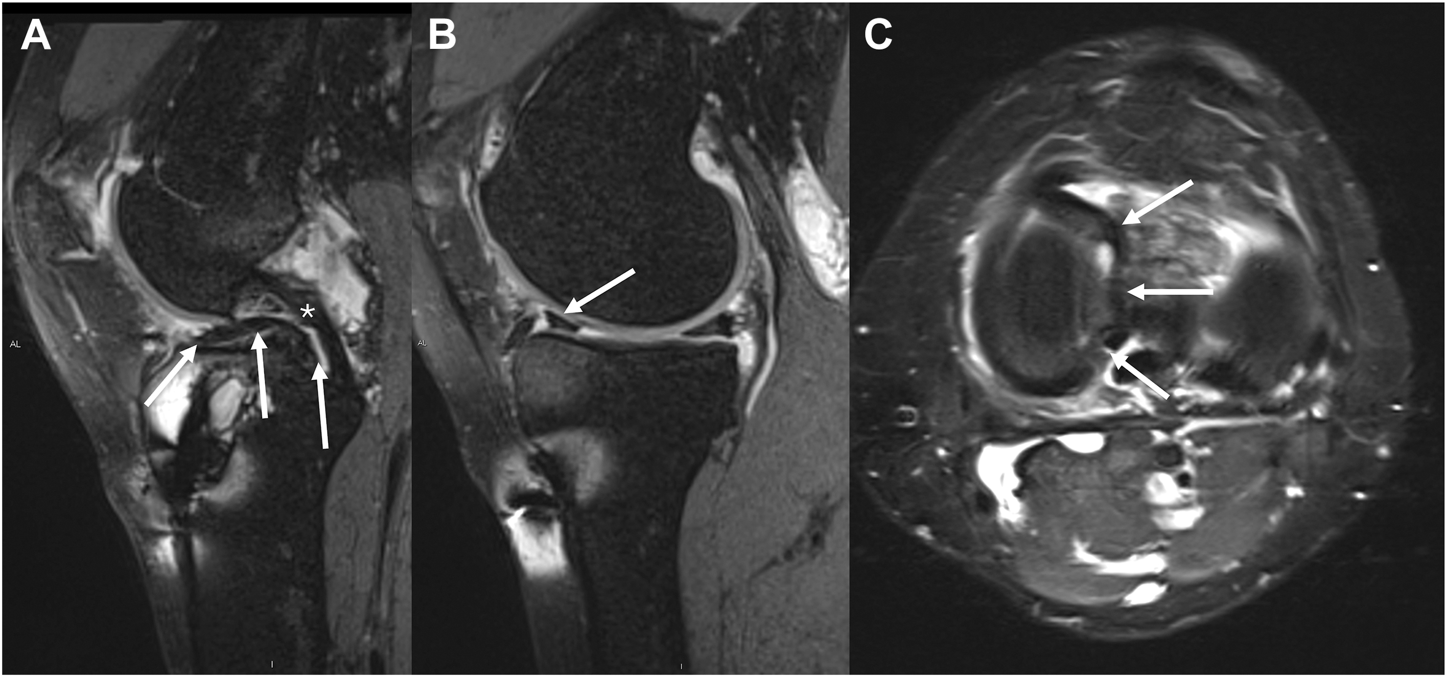A three-panel M R I of a left knee shows a complex bucket handle tear of the meniscus. The sagittal views demonstrate the double posterior cruciate ligament, P C L, sign.