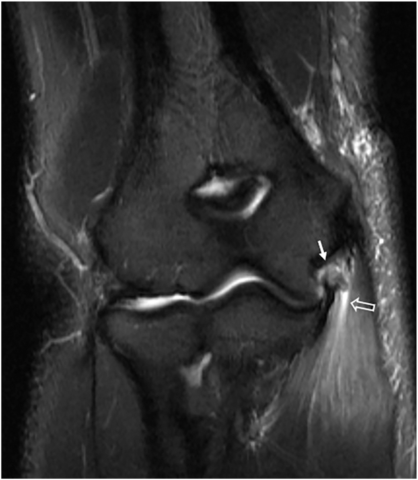 An M R I scan shows a coronal view of the elbow joint with a solid arrow marking the ligament attachment and an open arrow pointing to the surrounding tissue.